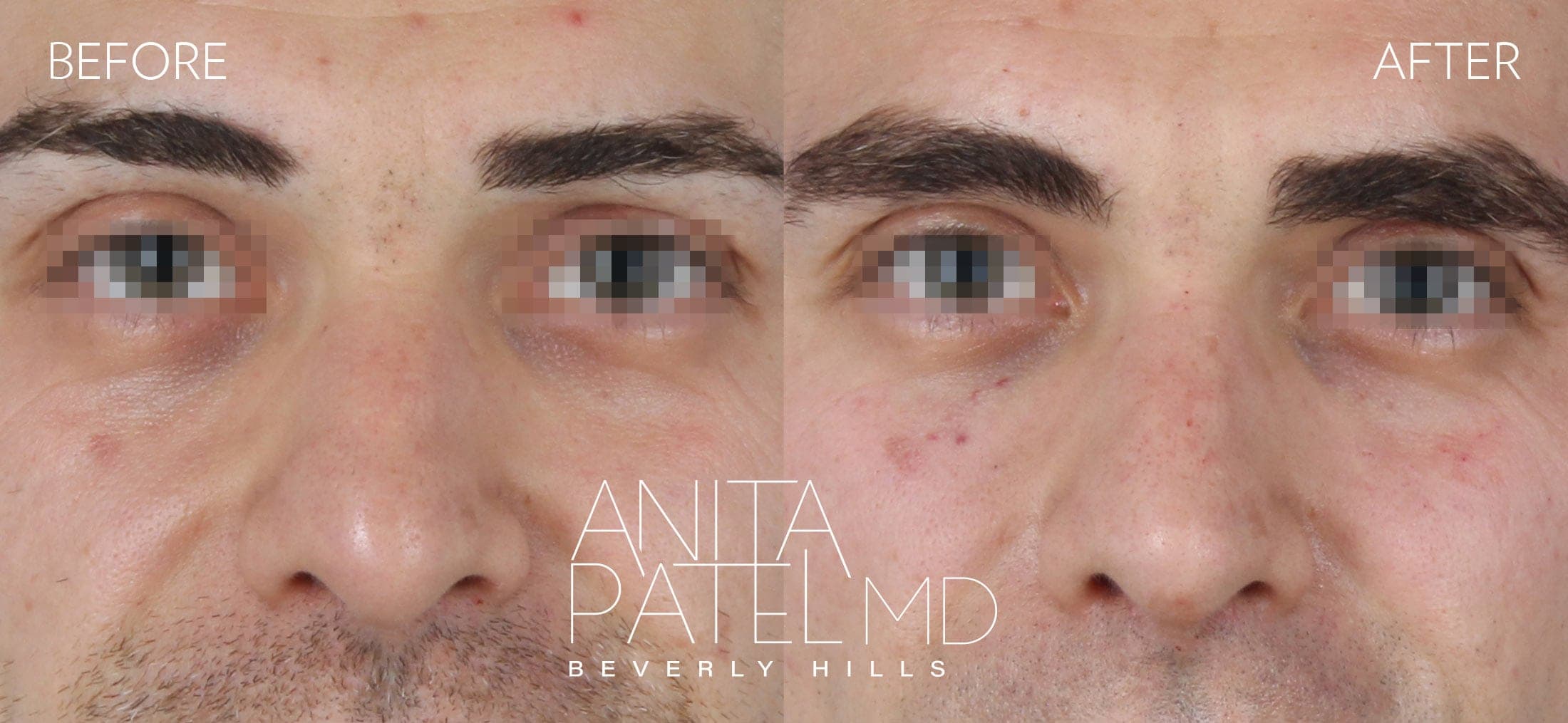 Liquid Rhinoplasty before and after — Patient 13, photo 1 of 3 — Dr. Anita Patel, MD, FACS, Beverly Hills