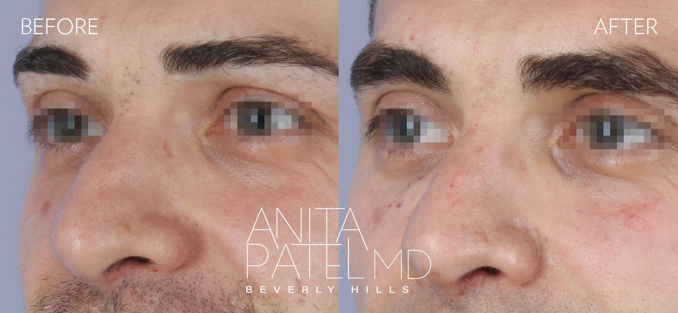 Liquid Rhinoplasty before and after — Patient 13, photo 2 of 3 — Dr. Anita Patel, MD, FACS, Beverly Hills