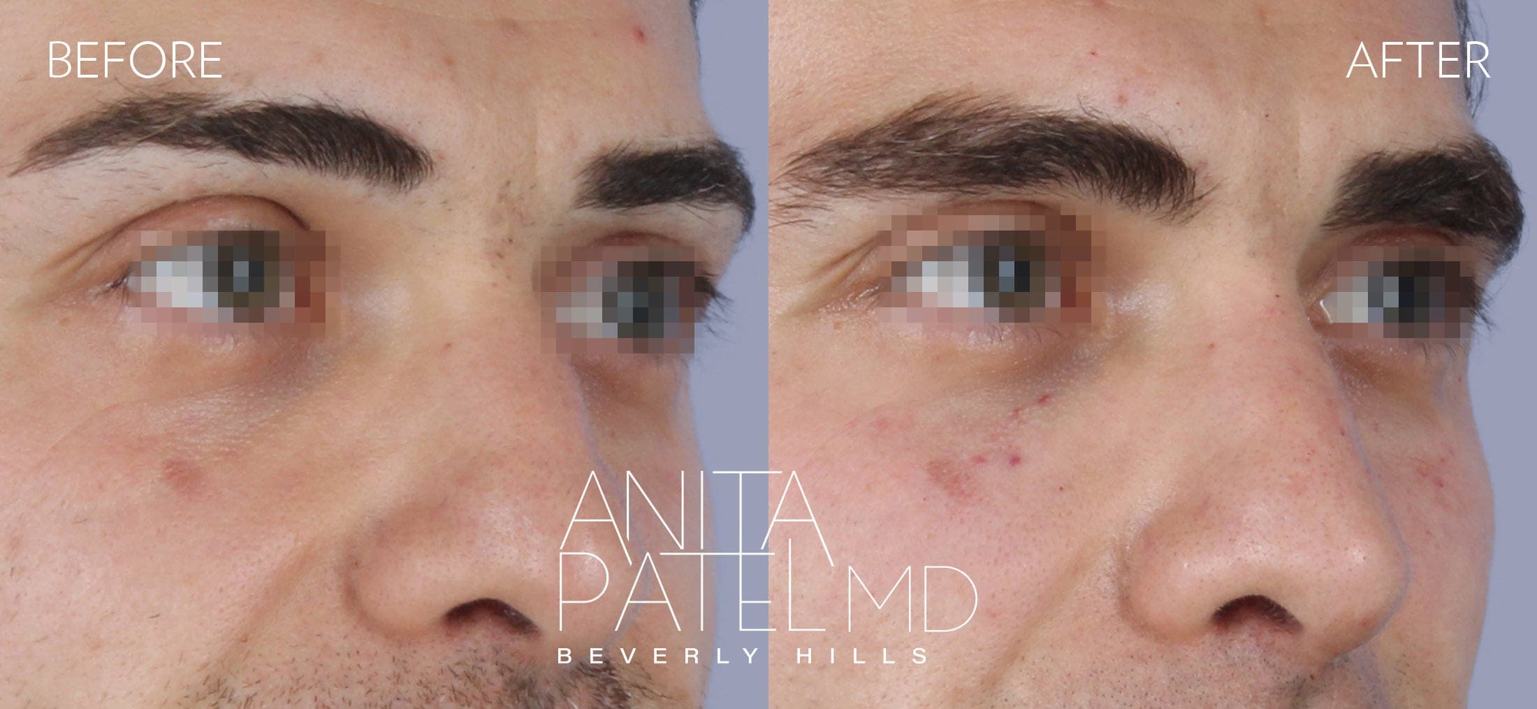 Liquid Rhinoplasty before and after — Patient 13, photo 3 of 3 — Dr. Anita Patel, MD, FACS, Beverly Hills