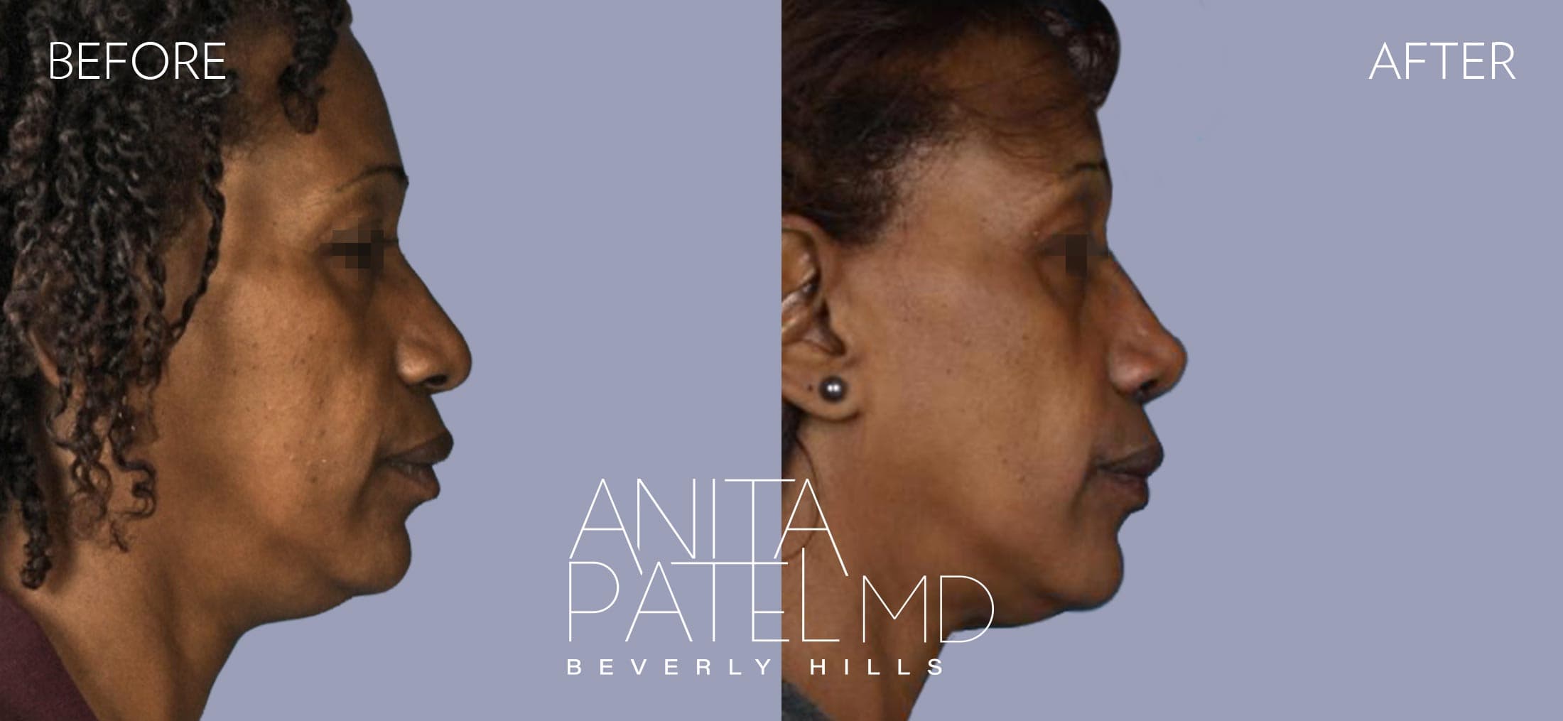 Rhinoplasty before and after — Patient 7 — Dr. Anita Patel, MD, FACS, Beverly Hills
