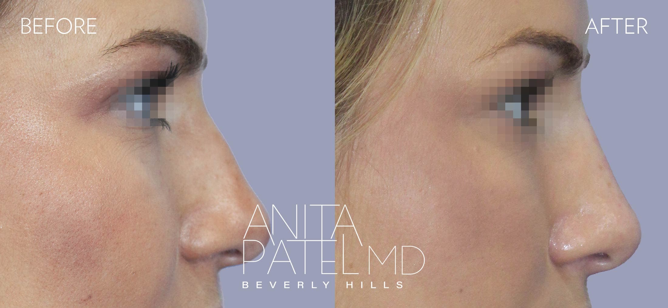Liquid Rhinoplasty before and after — Patient 9, photo 1 of 2 — Dr. Anita Patel, MD, FACS, Beverly Hills