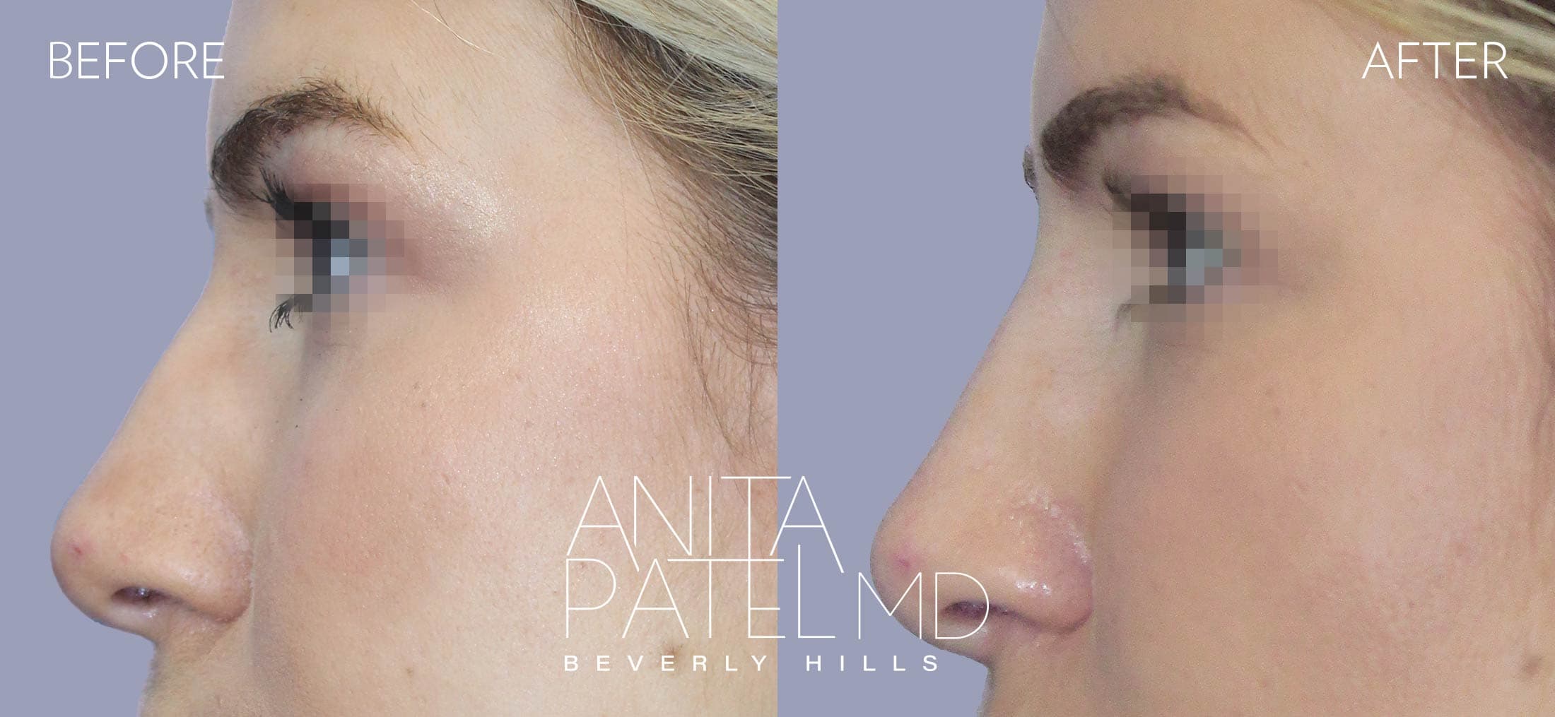Liquid Rhinoplasty before and after — Patient 9, photo 2 of 2 — Dr. Anita Patel, MD, FACS, Beverly Hills