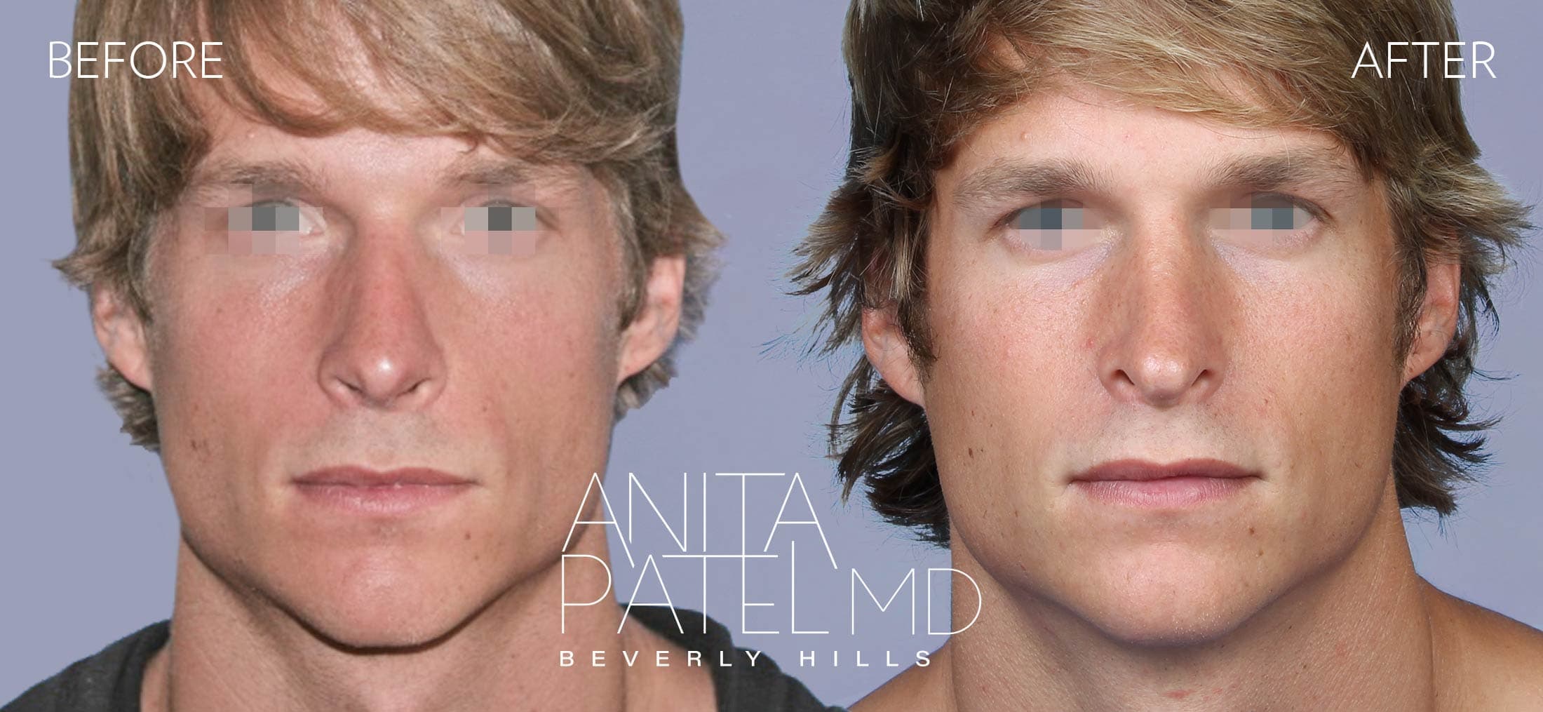 Rhinoplasty before and after — Patient 6 — Dr. Anita Patel, MD, FACS, Beverly Hills