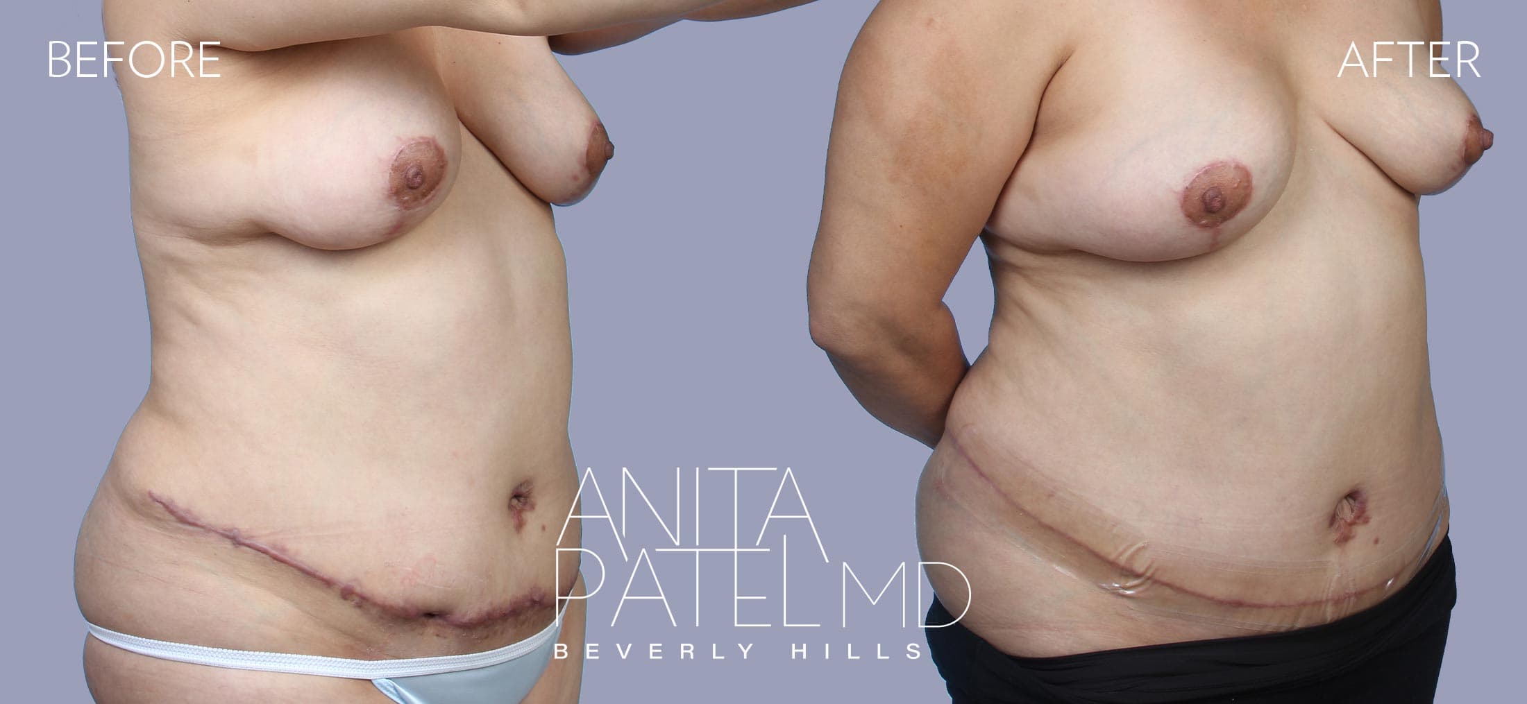 Scar Revision Removal before and after — Dr. Anita Patel, Beverly Hills