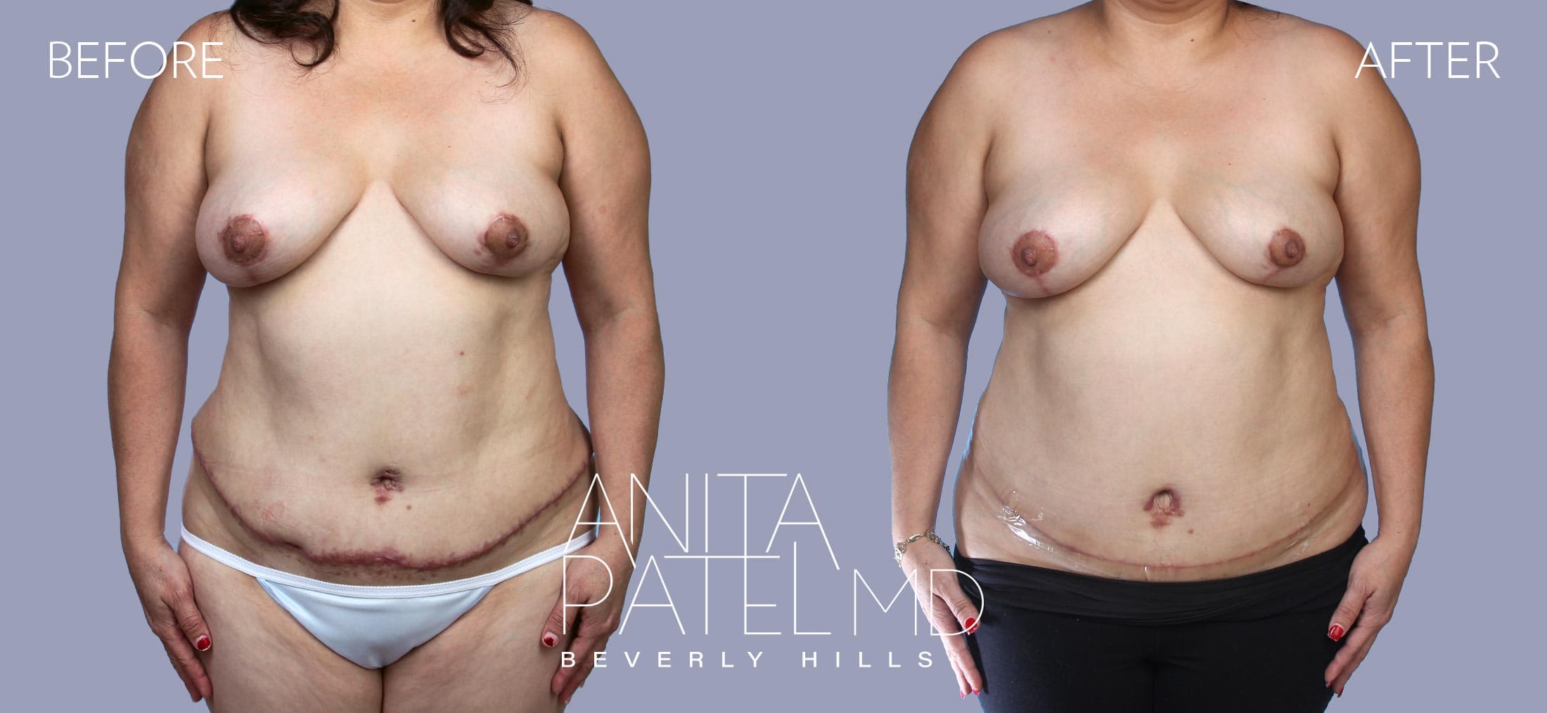 Scar Revision Removal before and after — Patient 1, photo 2 of 2 — Dr. Anita Patel, MD, FACS, Beverly Hills