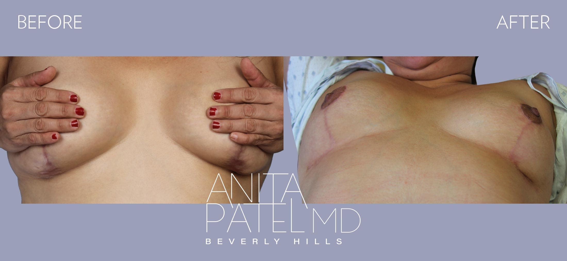 Scar Revision Removal before and after — Patient 2 — Dr. Anita Patel, MD, FACS, Beverly Hills