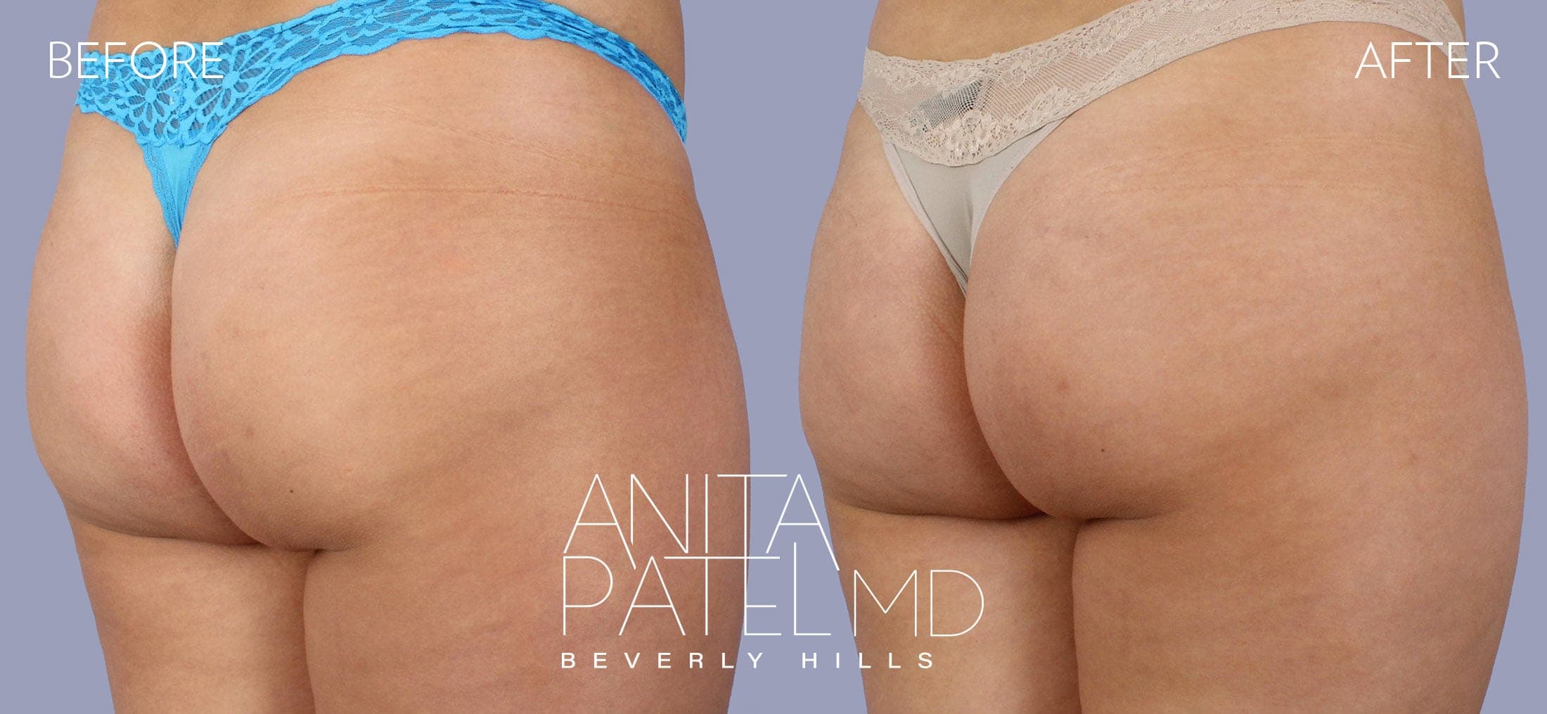 Sculptra before and after — Dr. Anita Patel, Beverly Hills