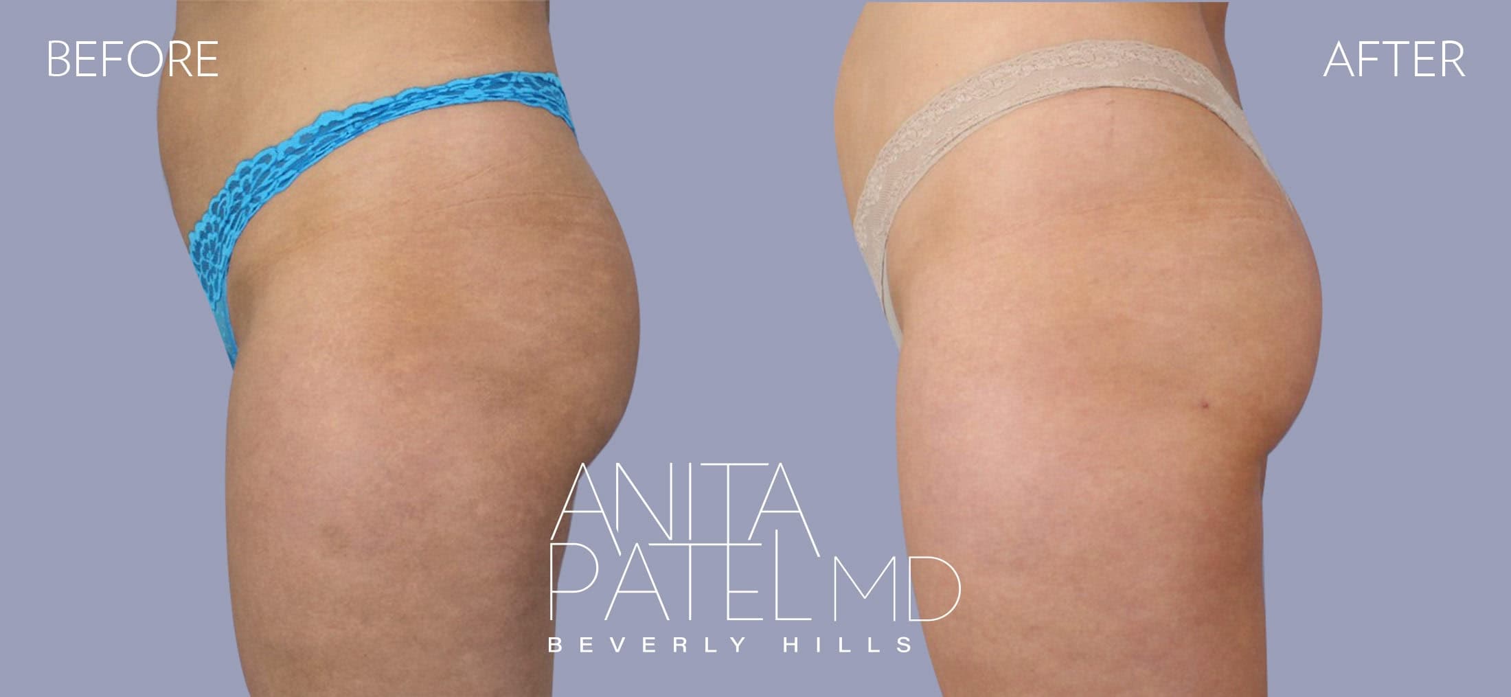 Sculptra before and after — Patient 1, photo 2 of 3 — Dr. Anita Patel, MD, FACS, Beverly Hills