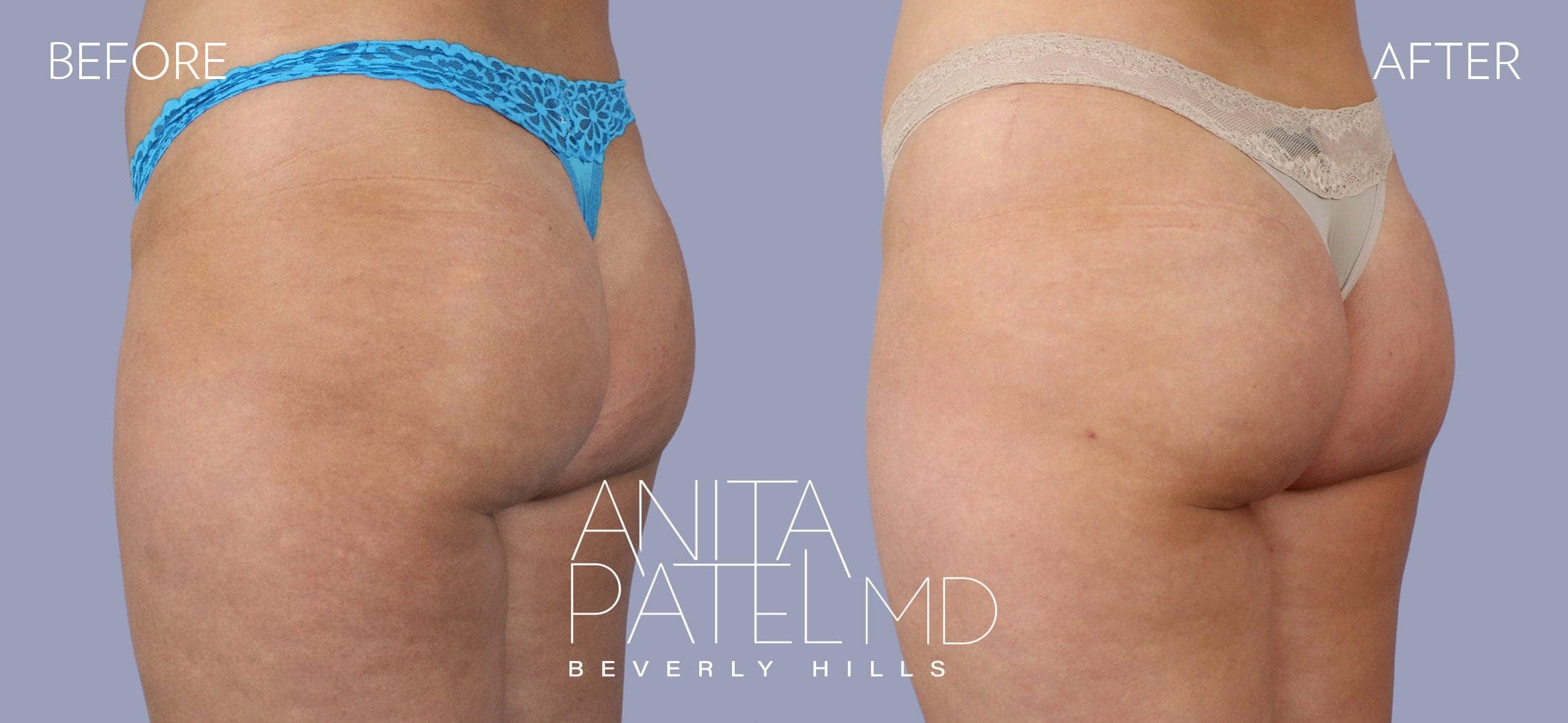 Sculptra before and after — Patient 1, photo 3 of 3 — Dr. Anita Patel, MD, FACS, Beverly Hills