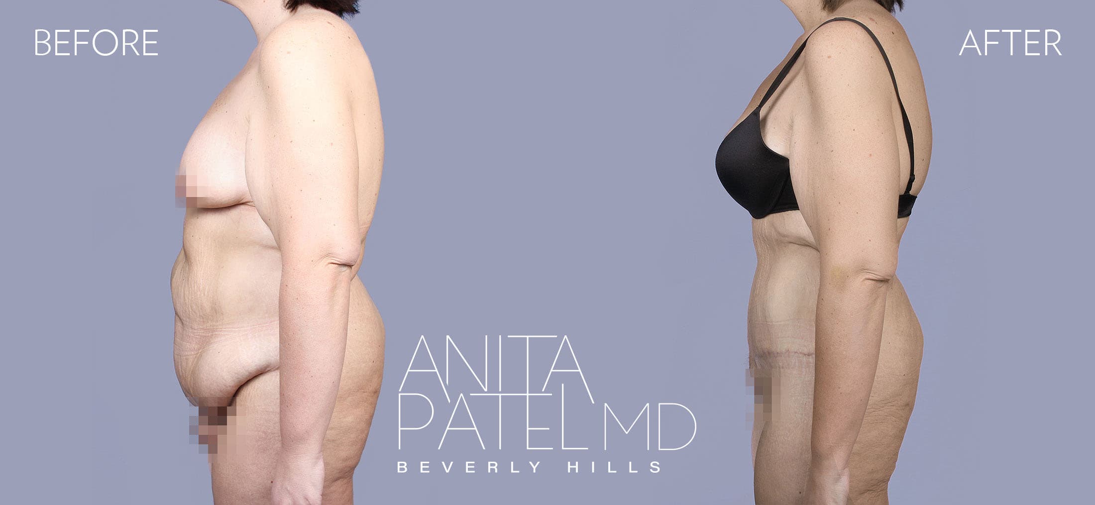 Tummy Tuck before and after — Patient 13, photo 1 of 3 — Dr. Anita Patel, MD, FACS, Beverly Hills