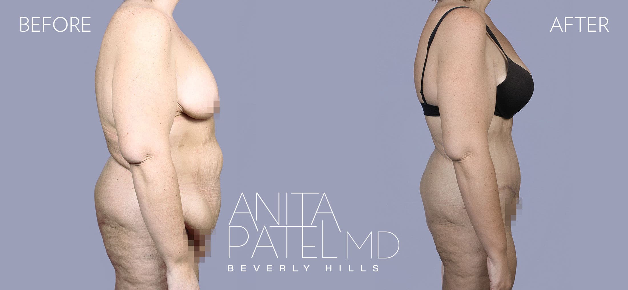Tummy Tuck before and after — Patient 13, photo 2 of 3 — Dr. Anita Patel, MD, FACS, Beverly Hills