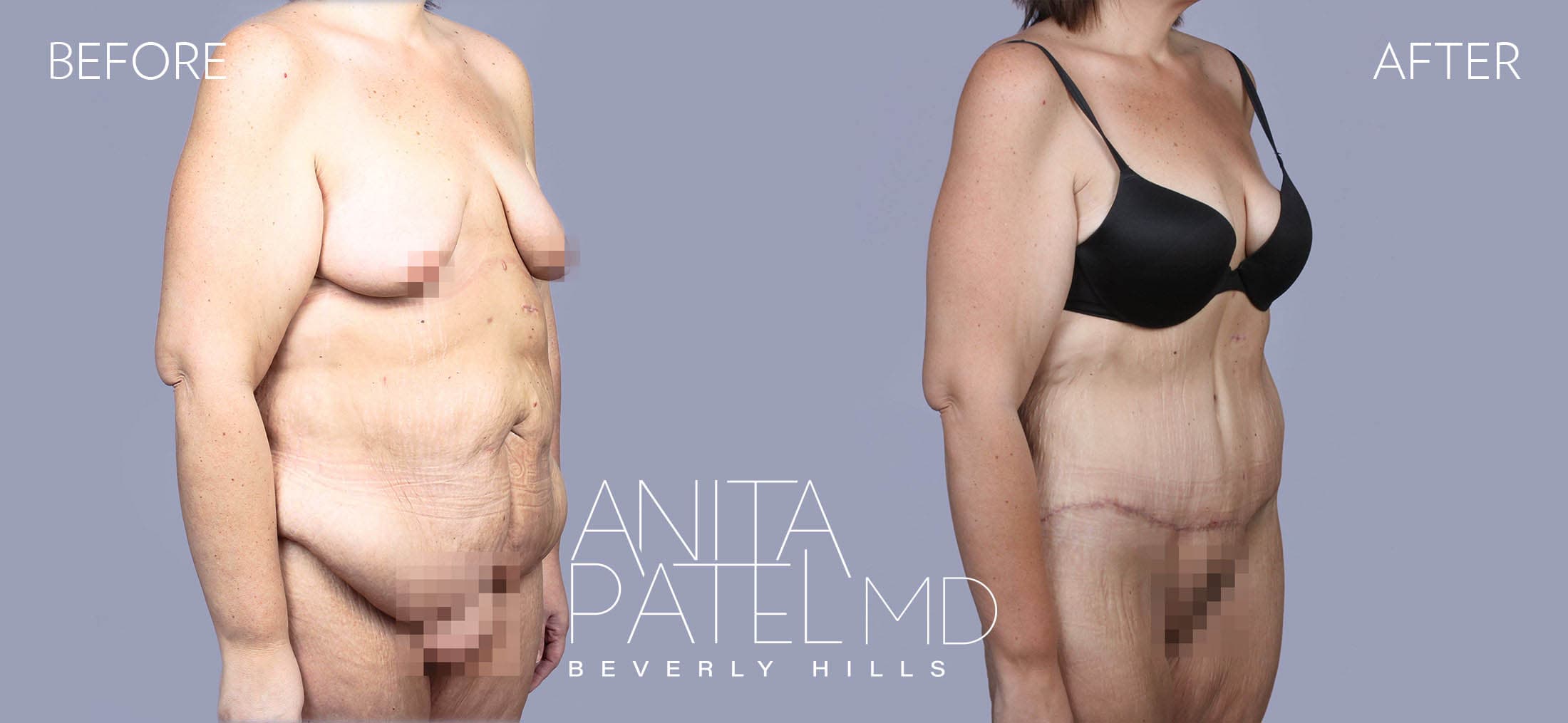 Tummy Tuck before and after — Patient 13, photo 3 of 3 — Dr. Anita Patel, MD, FACS, Beverly Hills