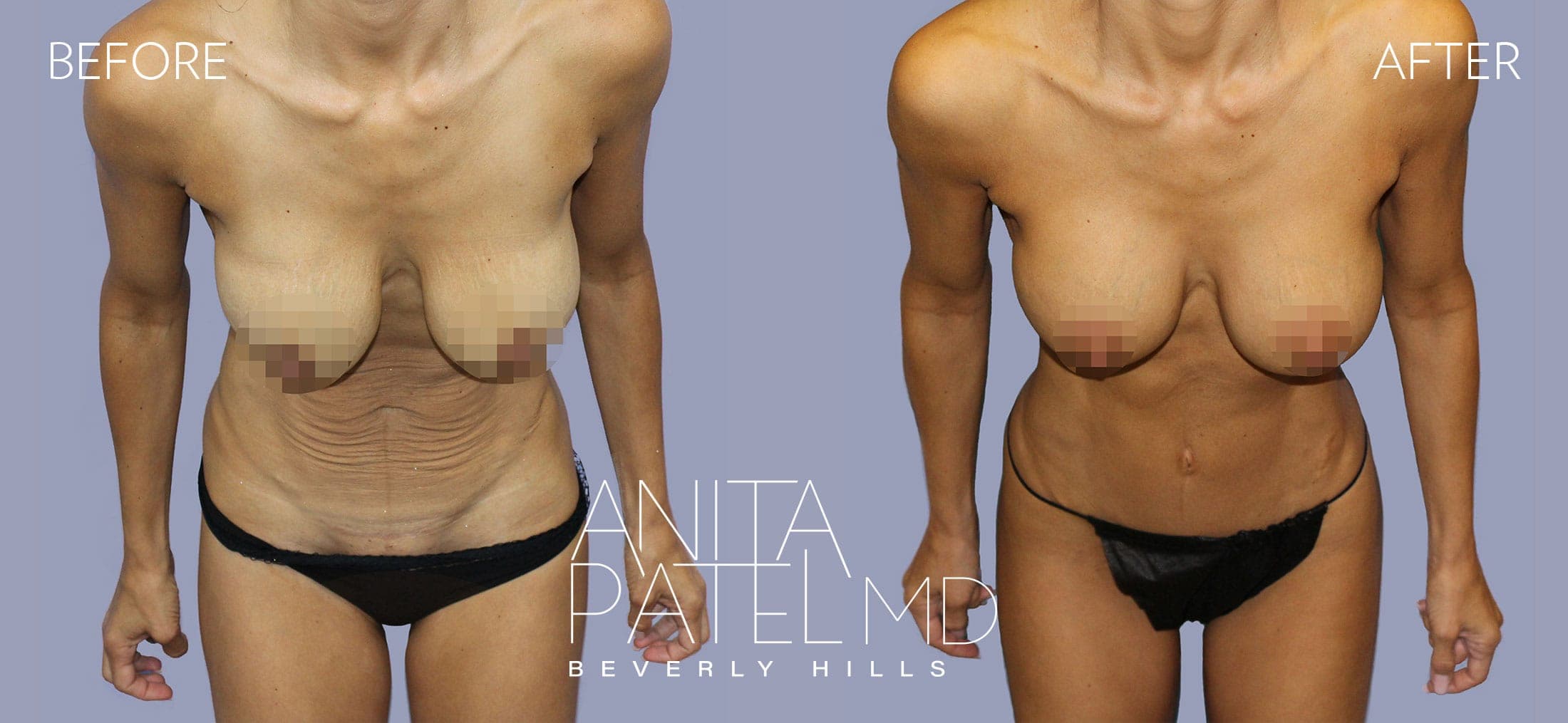 Tummy Tuck before and after — Patient 14 — Dr. Anita Patel, MD, FACS, Beverly Hills