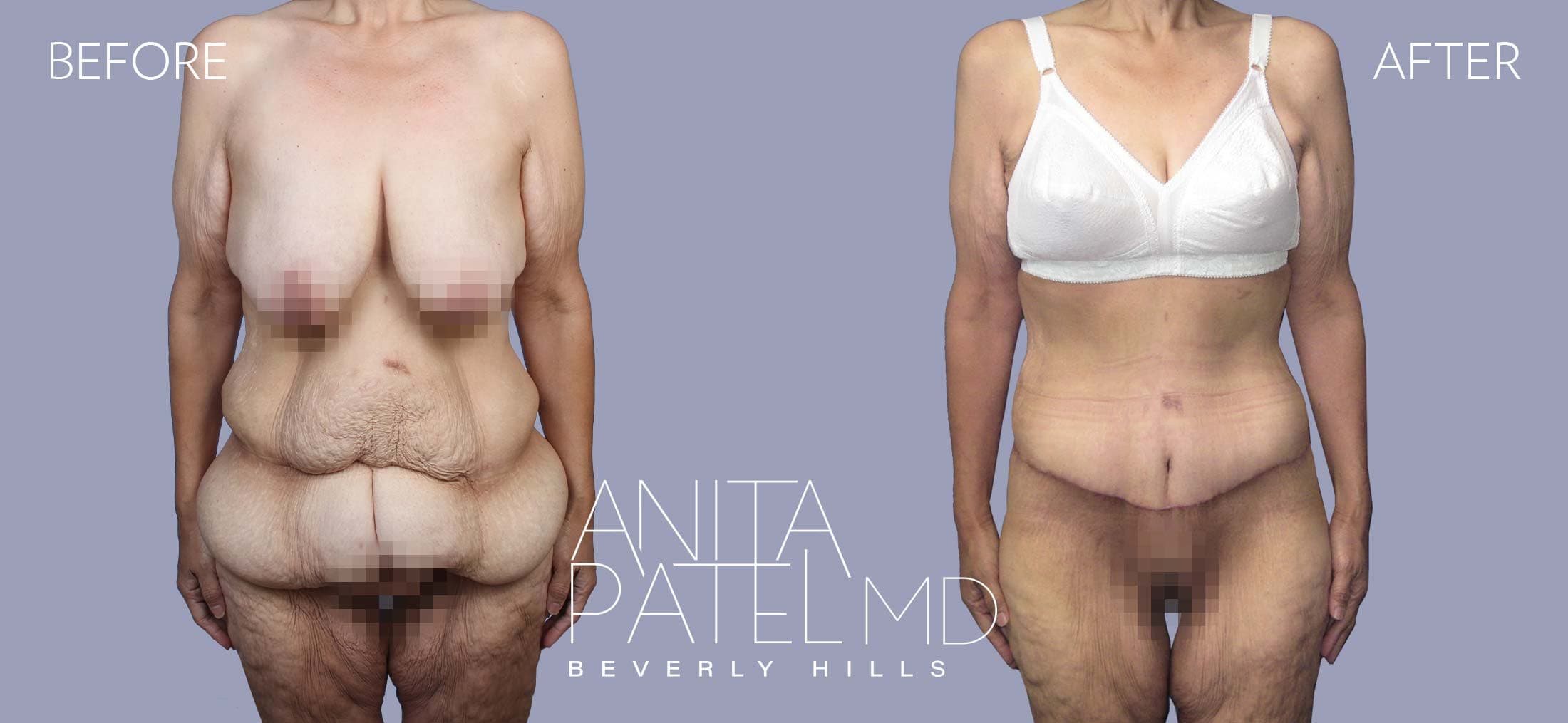 Tummy Tuck before and after — Patient 19 — Dr. Anita Patel, MD, FACS, Beverly Hills