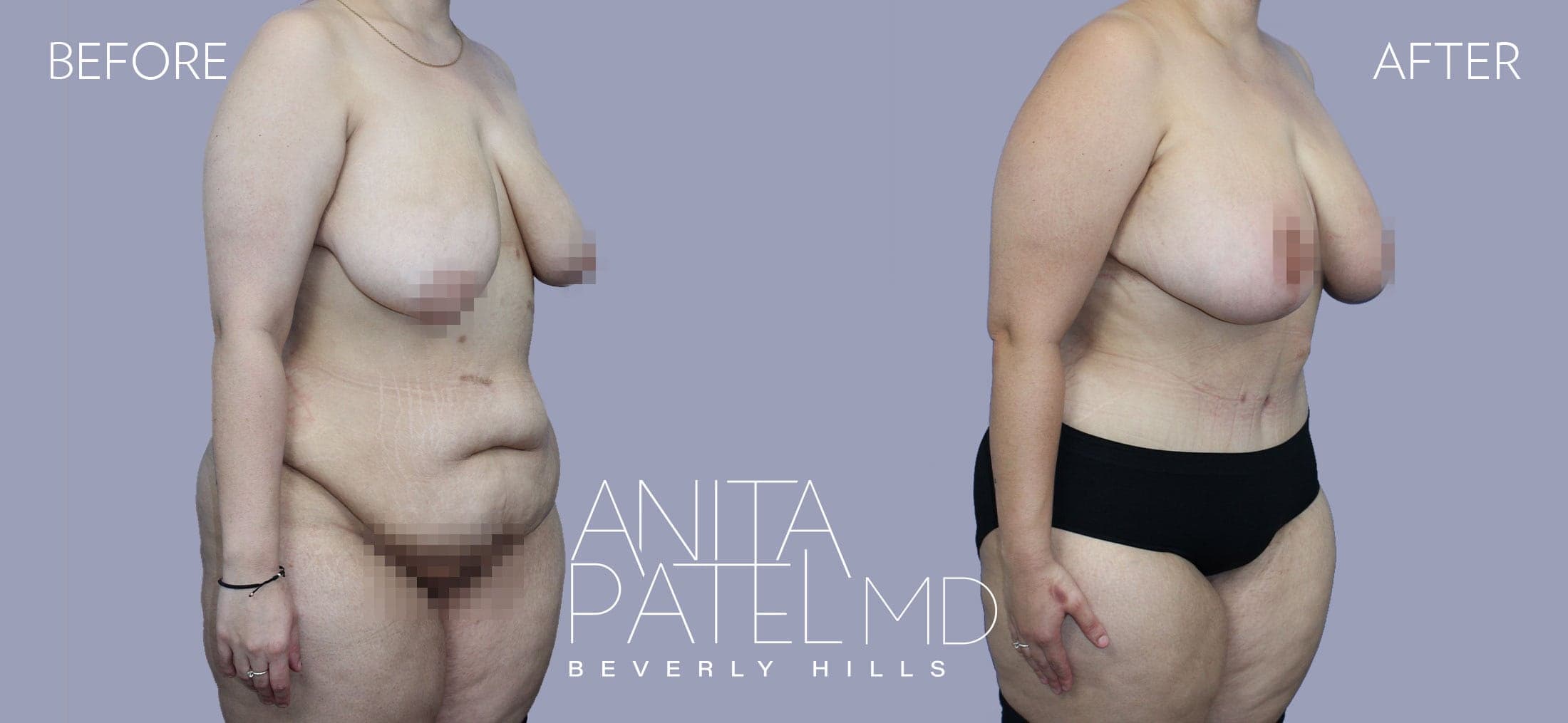 Tummy Tuck before and after — Patient 24 — Dr. Anita Patel, MD, FACS, Beverly Hills