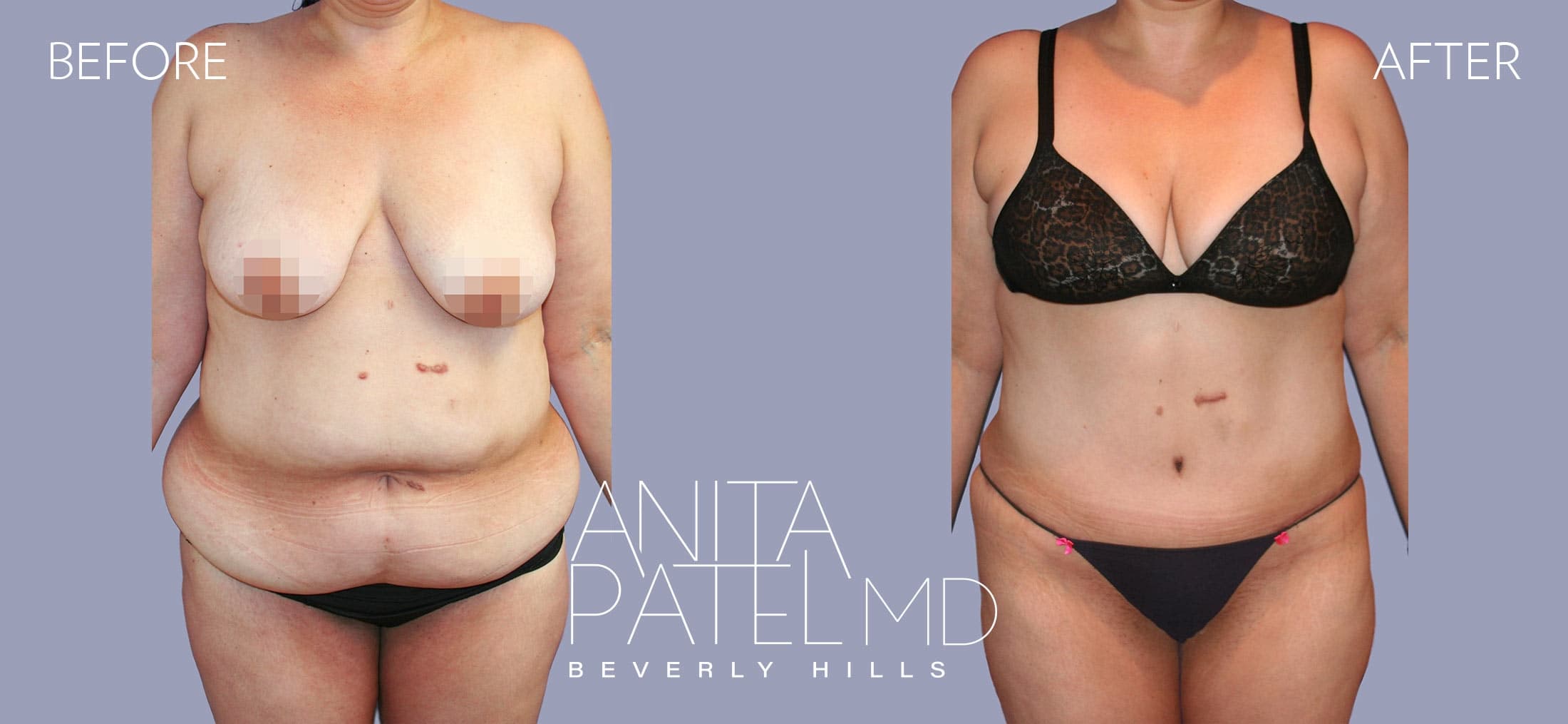 Tummy Tuck before and after — Patient 15a — Dr. Anita Patel, MD, FACS, Beverly Hills