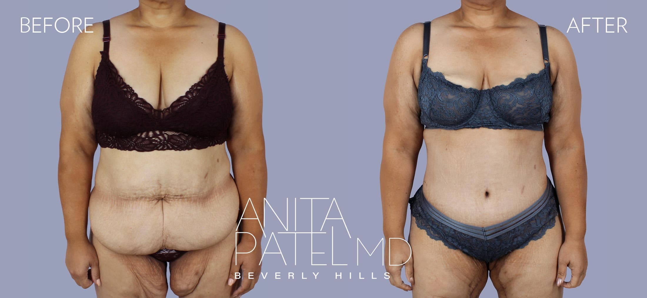 Tummy Tuck before and after — Patient 29 — Dr. Anita Patel, MD, FACS, Beverly Hills