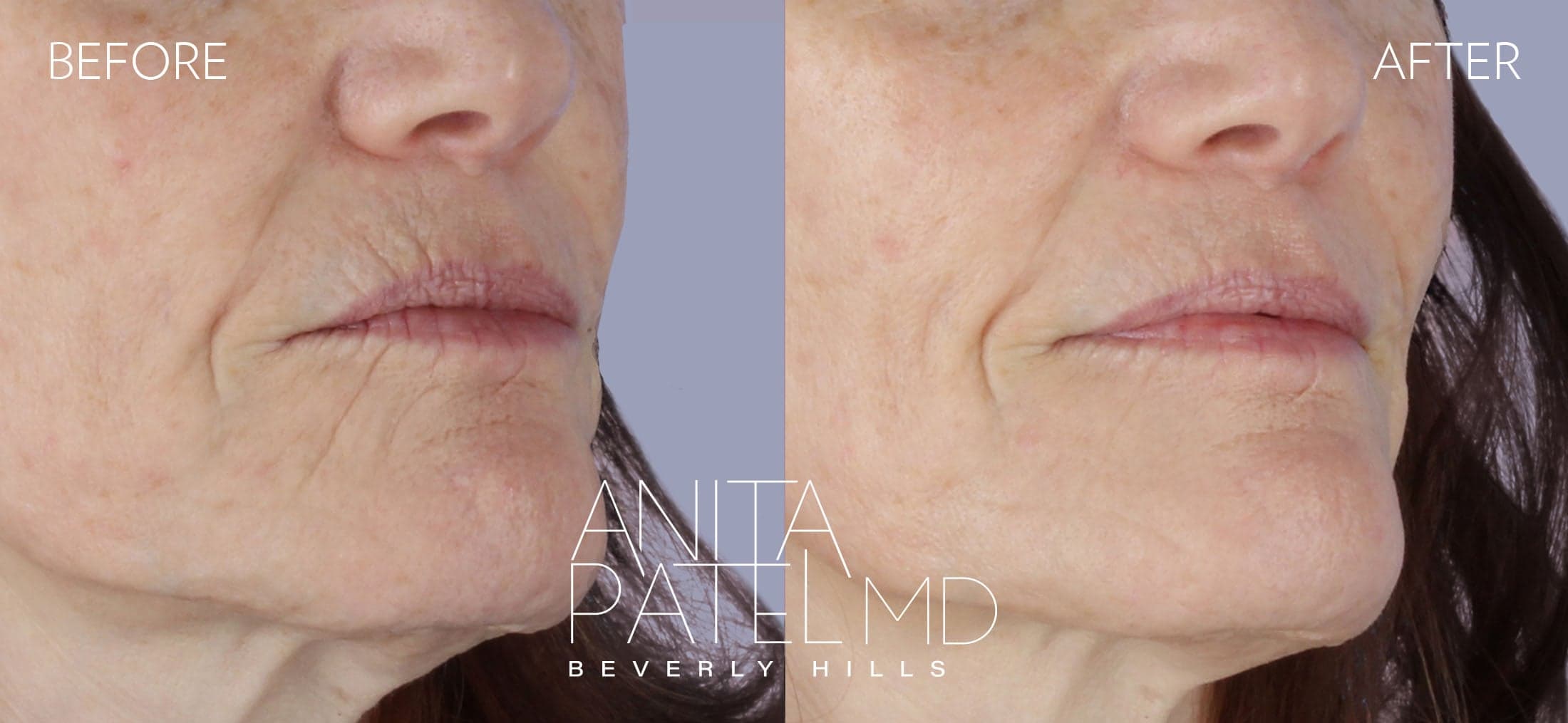 THERMIsmooth® Face Skin Tightening before and after — Patient 1 — Dr. Anita Patel, MD, FACS, Beverly Hills