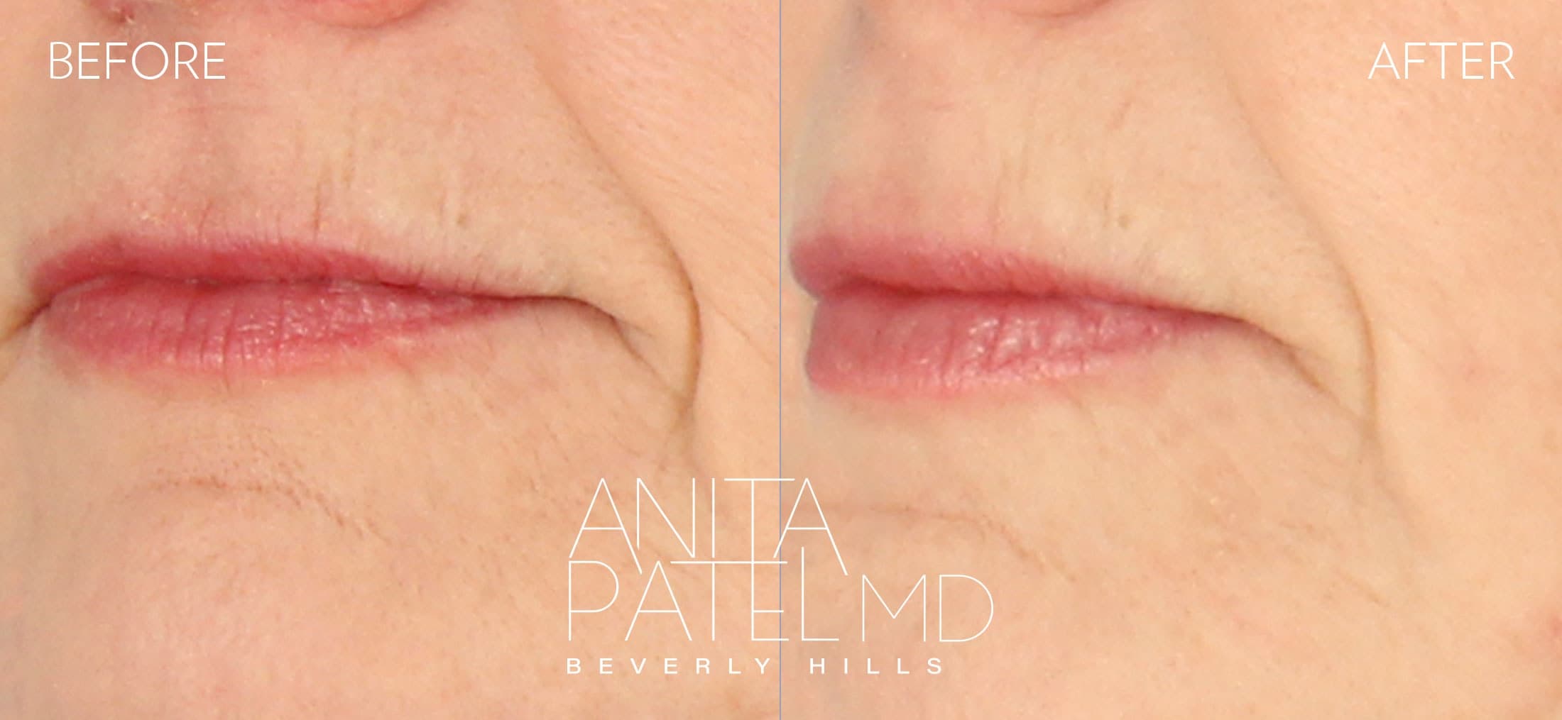 THERMIsmooth® Face Skin Tightening before and after — Patient 3, photo 1 of 2 — Dr. Anita Patel, MD, FACS, Beverly Hills