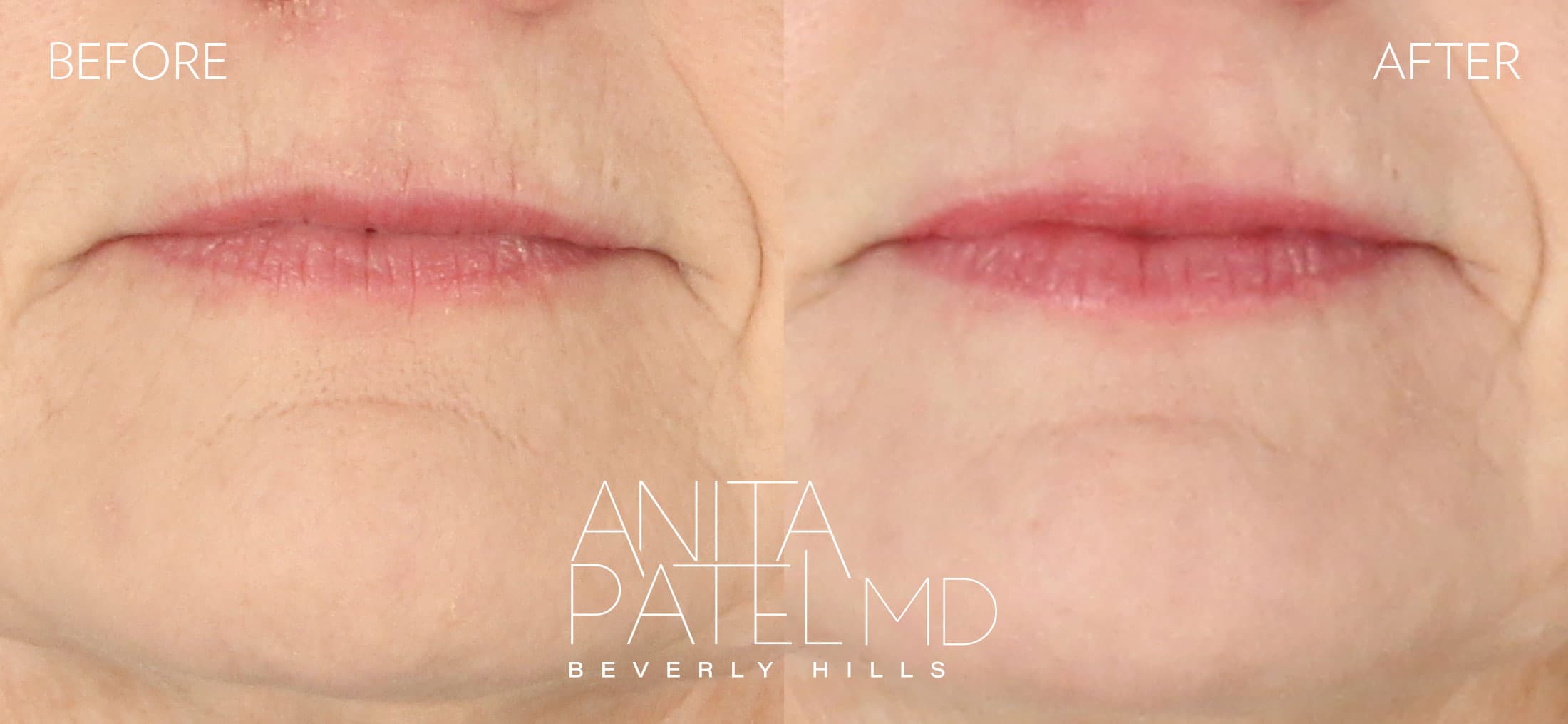 THERMIsmooth® Face Skin Tightening before and after — Patient 3, photo 2 of 2 — Dr. Anita Patel, MD, FACS, Beverly Hills