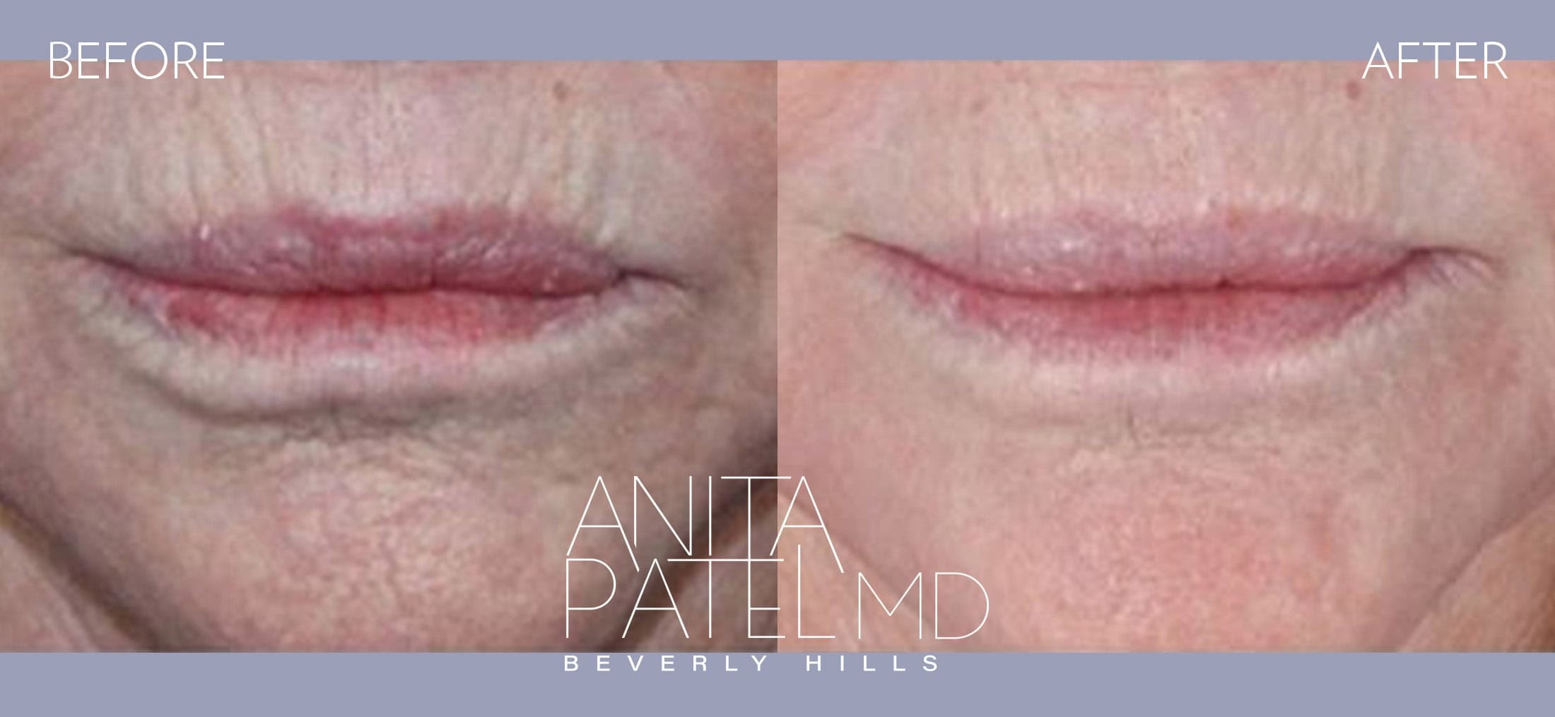 THERMIsmooth® Face Skin Tightening before and after — Patient 4 — Dr. Anita Patel, MD, FACS, Beverly Hills
