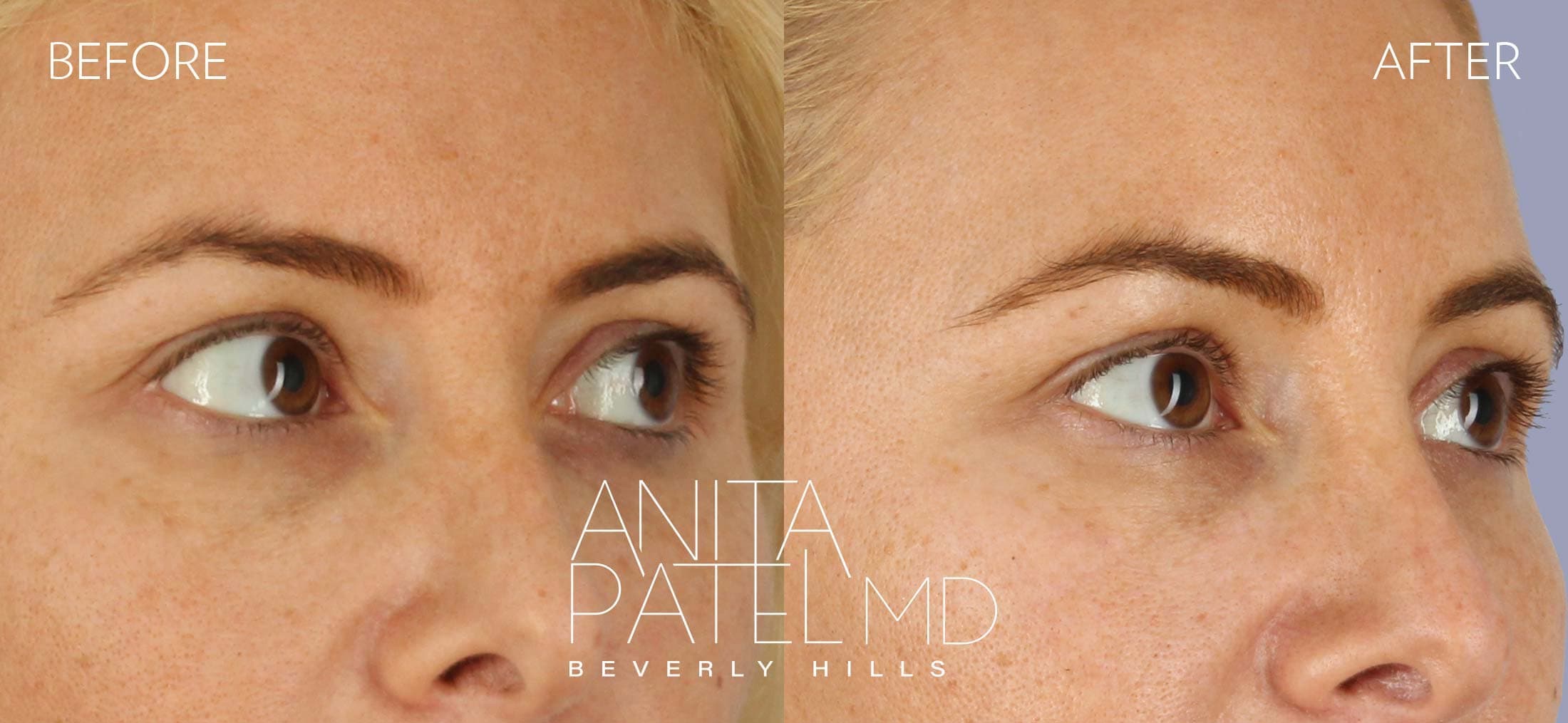 THERMIsmooth® Face Skin Tightening before and after — Patient 1, photo 2 of 3 — Dr. Anita Patel, MD, FACS, Beverly Hills