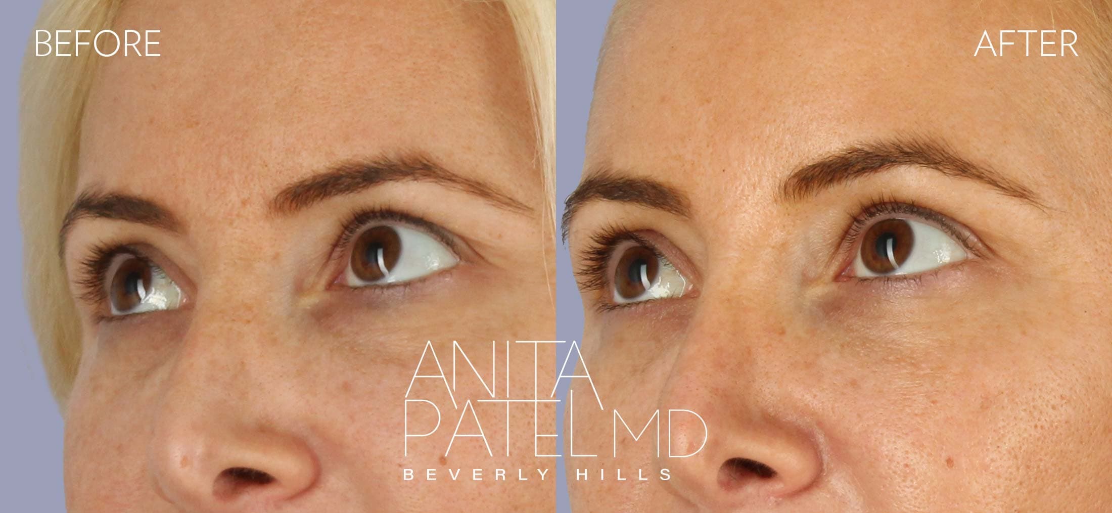THERMIsmooth® Face Skin Tightening before and after — Patient 1, photo 3 of 3 — Dr. Anita Patel, MD, FACS, Beverly Hills