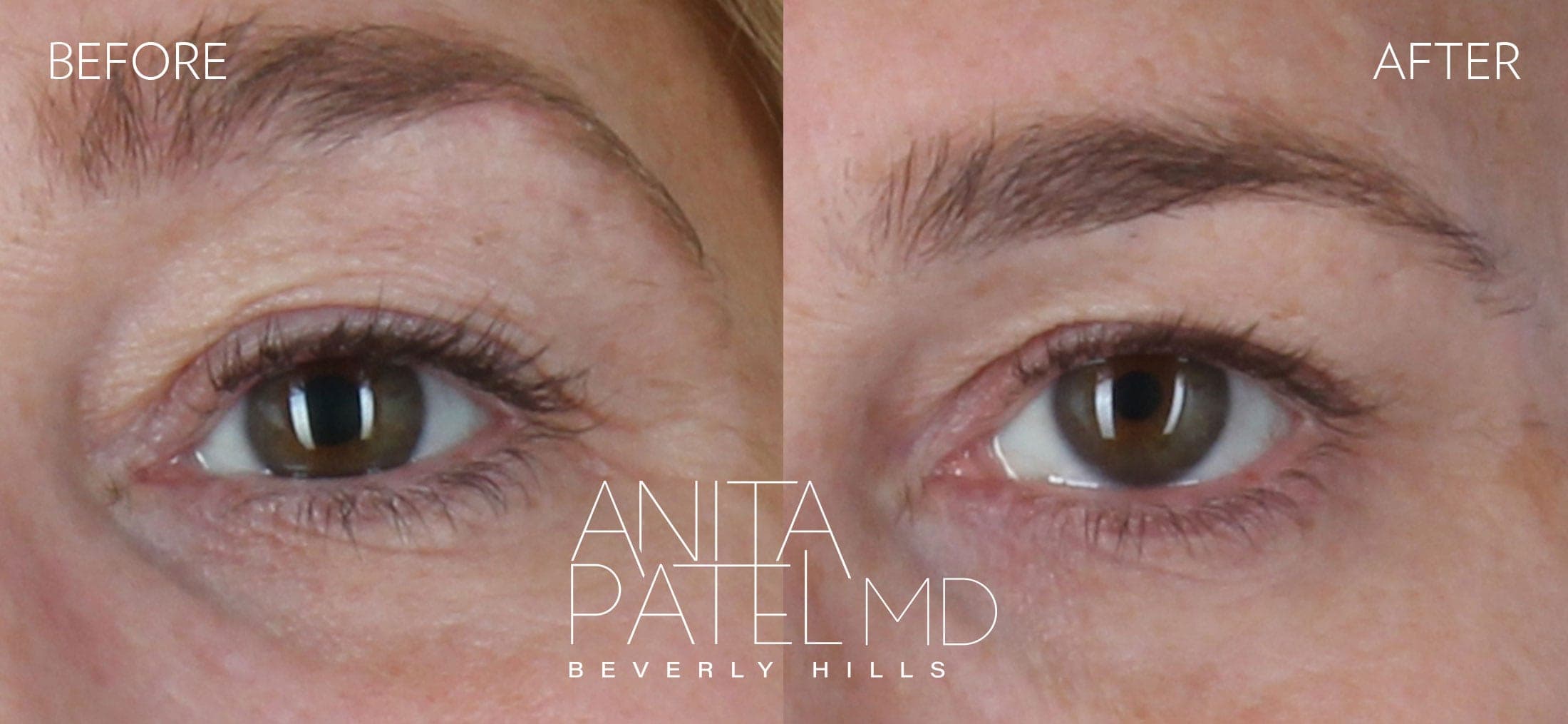 THERMIsmooth® Face Skin Tightening before and after — Patient 4 — Dr. Anita Patel, MD, FACS, Beverly Hills