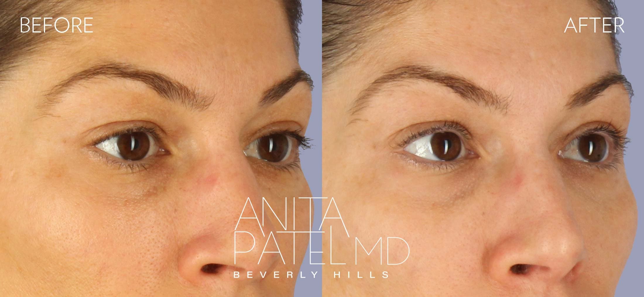 THERMIsmooth® Face Skin Tightening before and after — Patient 5, photo 2 of 4 — Dr. Anita Patel, MD, FACS, Beverly Hills