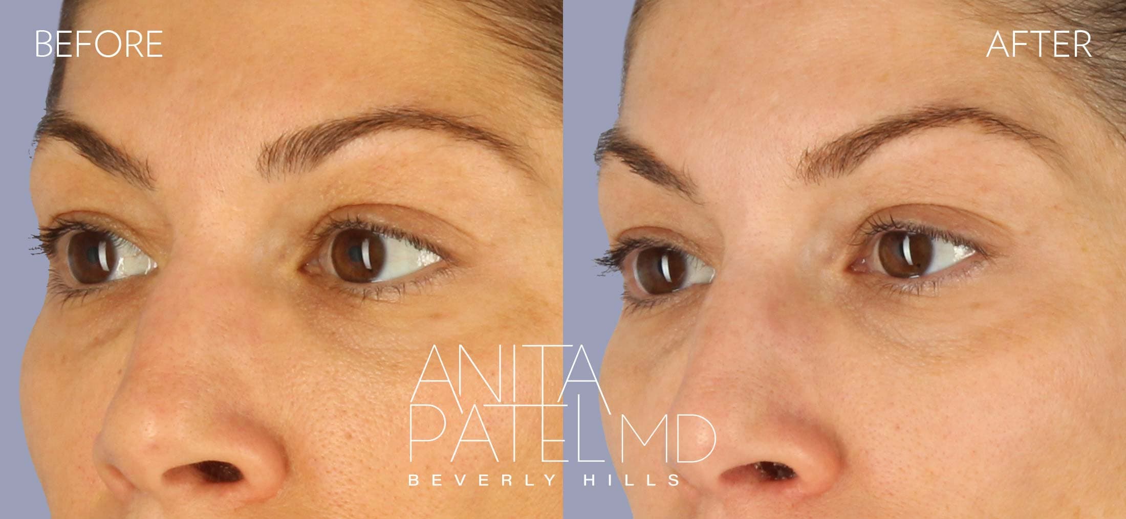 THERMIsmooth® Face Skin Tightening before and after — Patient 5, photo 3 of 4 — Dr. Anita Patel, MD, FACS, Beverly Hills