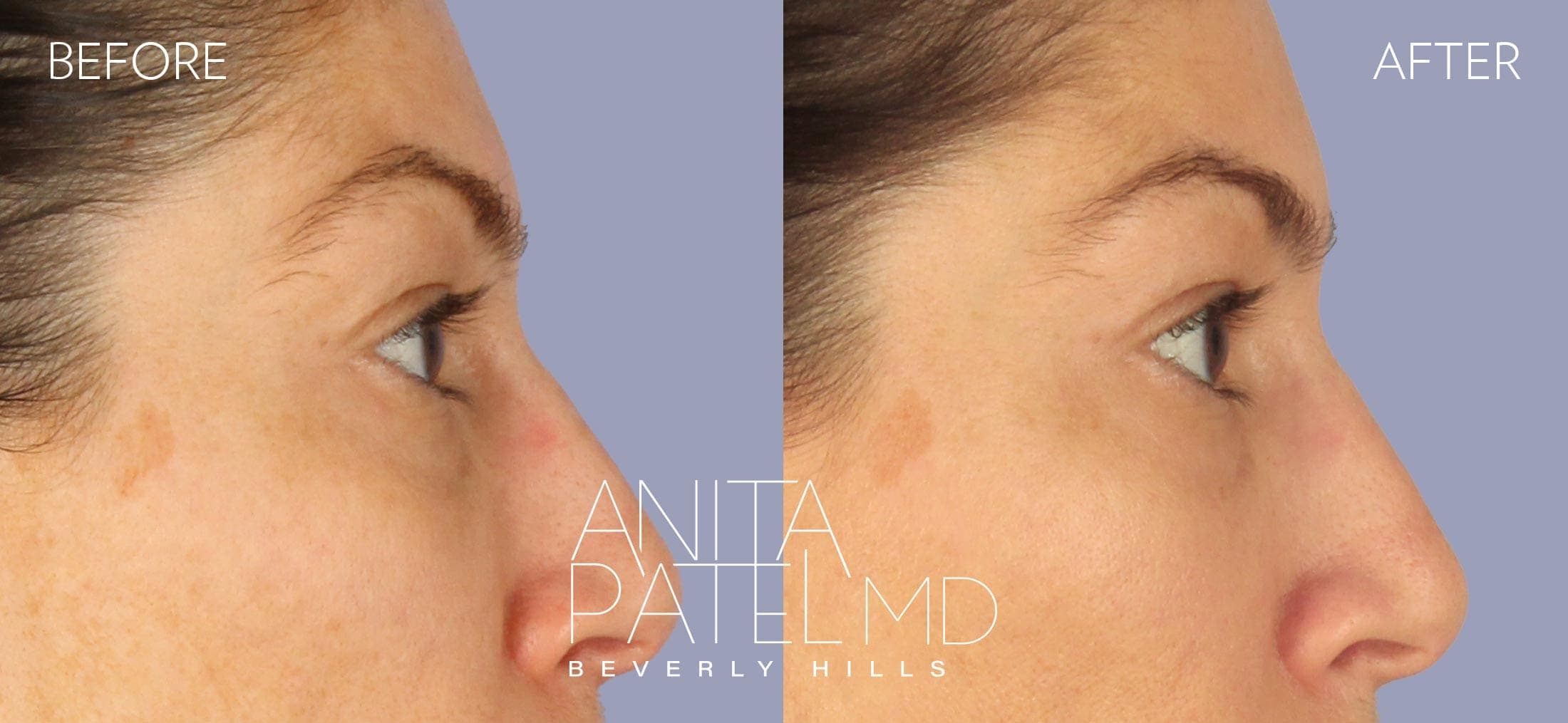 THERMIsmooth® Face Skin Tightening before and after — Patient 5, photo 4 of 4 — Dr. Anita Patel, MD, FACS, Beverly Hills