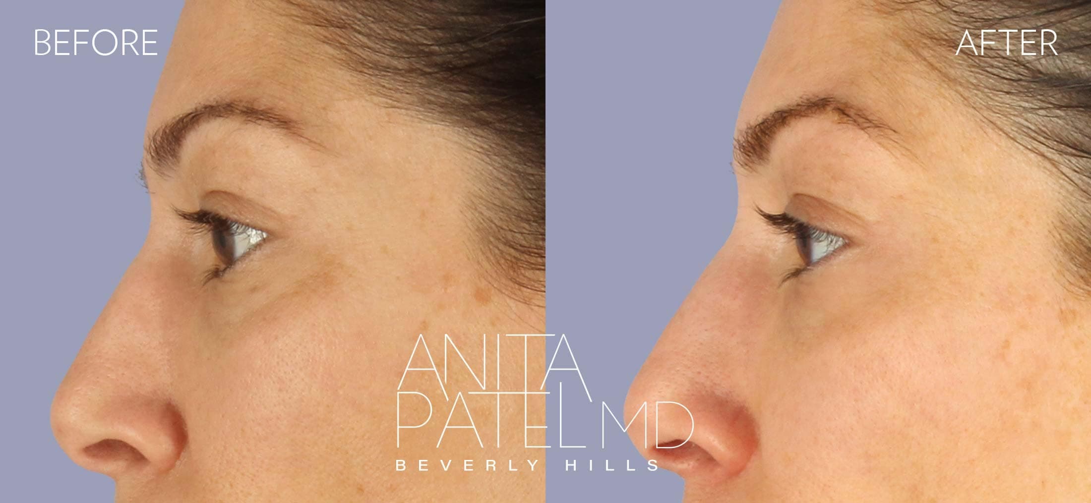 THERMIsmooth® Face Skin Tightening before and after — Patient 5, photo 1 of 4 — Dr. Anita Patel, MD, FACS, Beverly Hills