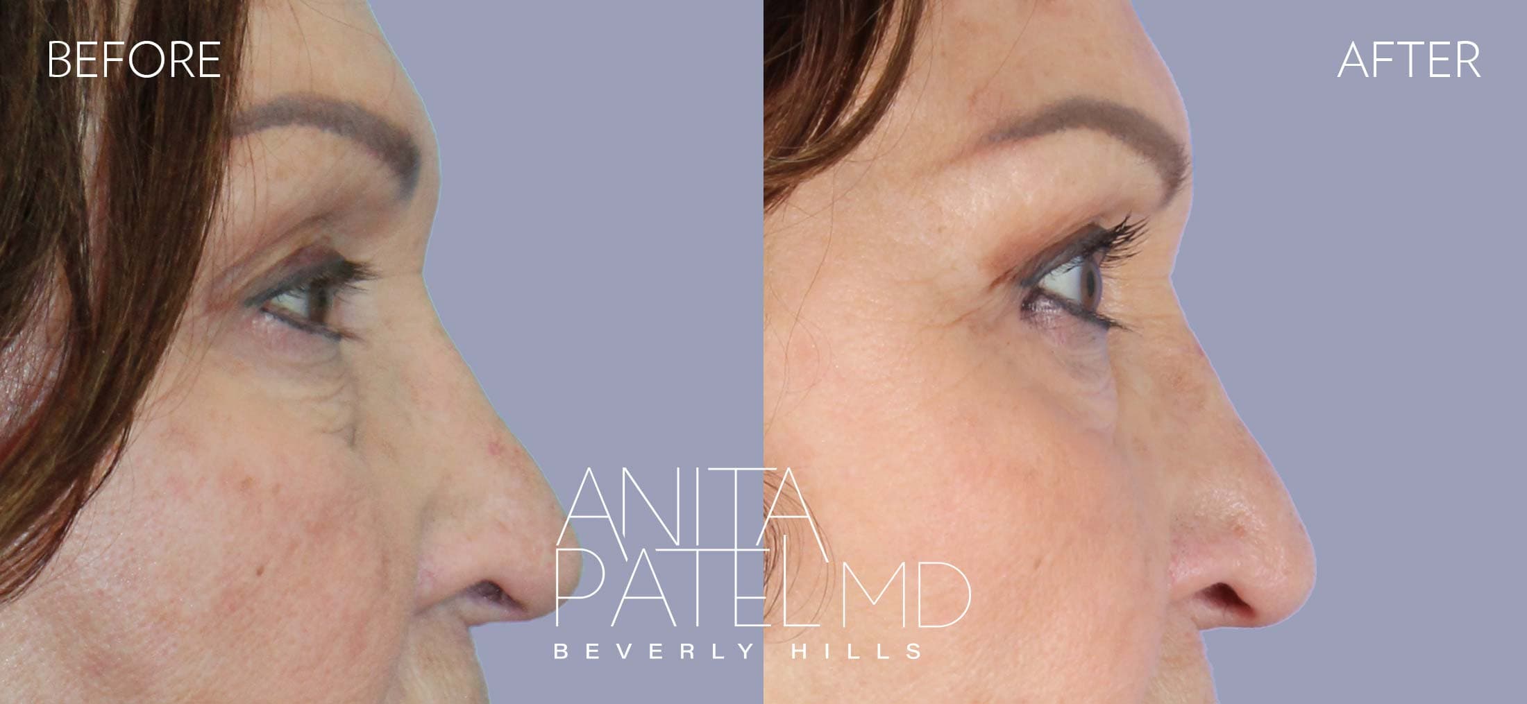 THERMIsmooth® Face Skin Tightening before and after — Patient 7, photo 2 of 5 — Dr. Anita Patel, MD, FACS, Beverly Hills