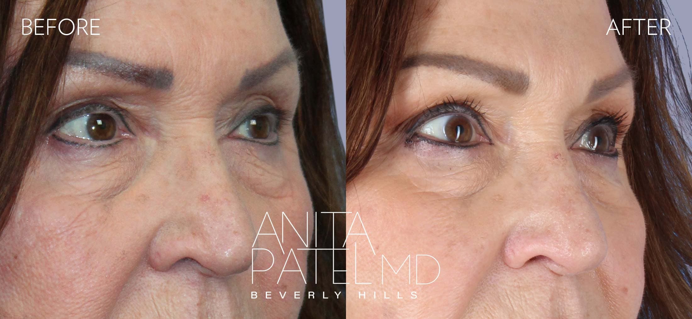 THERMIsmooth® Face Skin Tightening before and after — Patient 7, photo 3 of 5 — Dr. Anita Patel, MD, FACS, Beverly Hills
