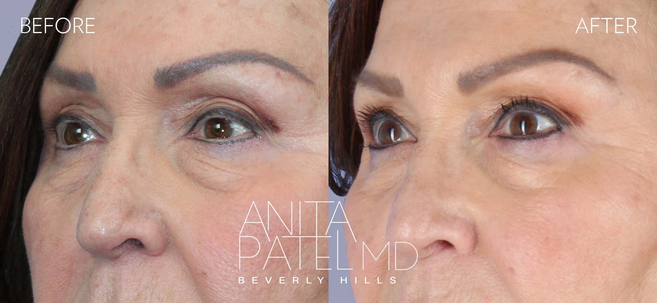 THERMIsmooth® Face Skin Tightening before and after — Patient 7, photo 4 of 5 — Dr. Anita Patel, MD, FACS, Beverly Hills