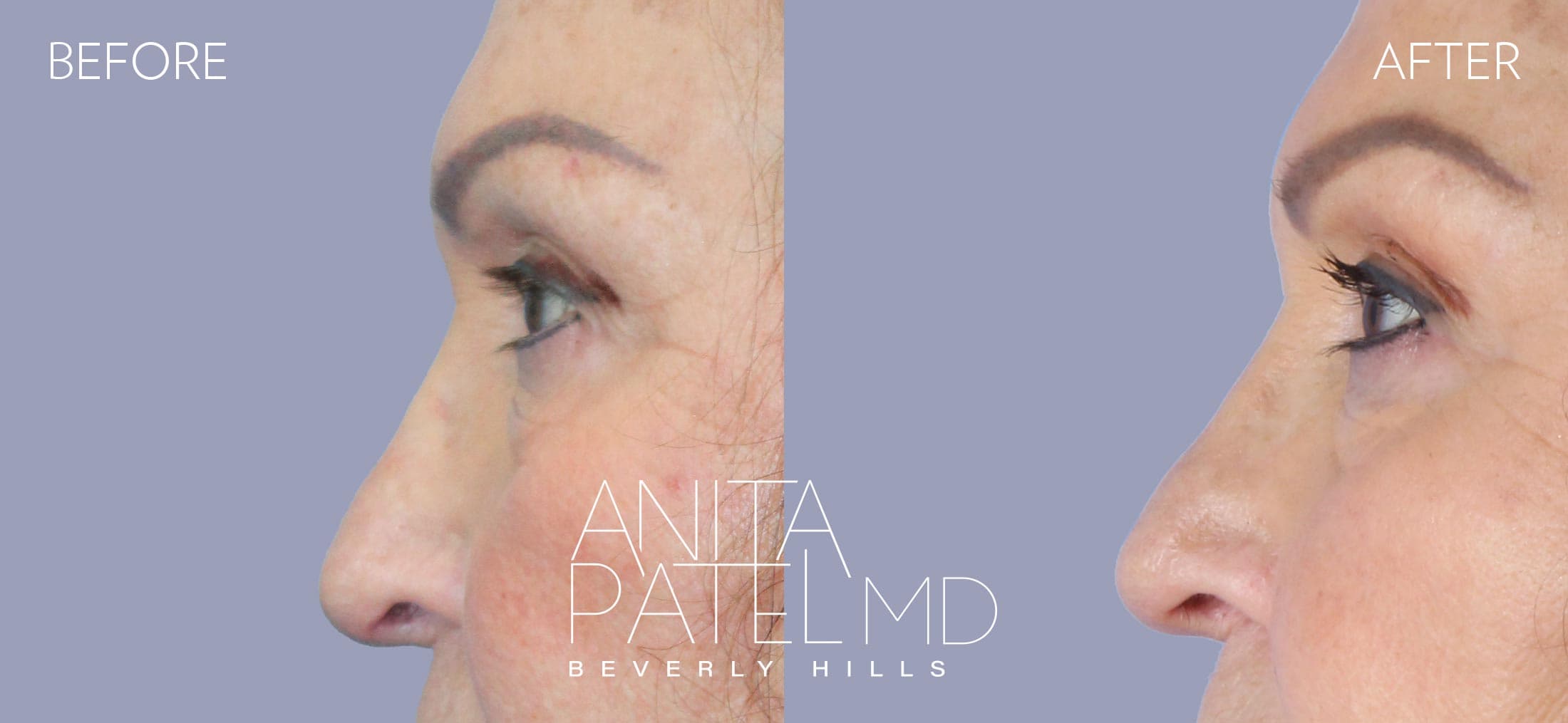 THERMIsmooth® Face Skin Tightening before and after — Patient 7, photo 5 of 5 — Dr. Anita Patel, MD, FACS, Beverly Hills