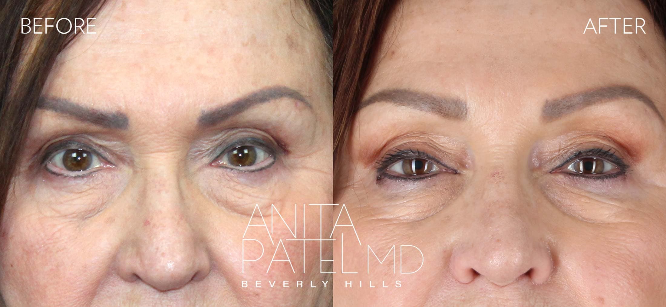 THERMIsmooth® Face Skin Tightening before and after — Patient 7, photo 1 of 5 — Dr. Anita Patel, MD, FACS, Beverly Hills