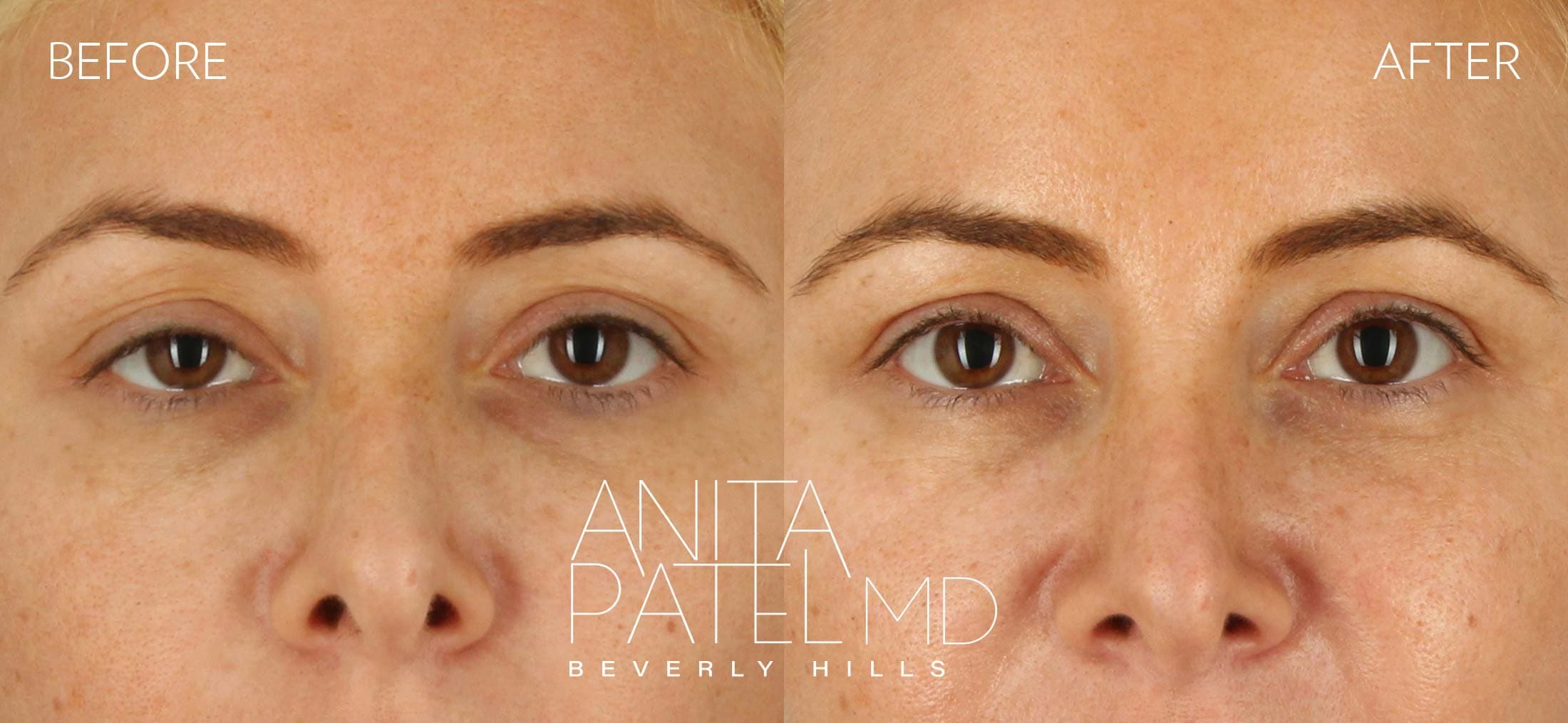 THERMIsmooth® Face Skin Tightening before and after — Patient 1, photo 1 of 3 — Dr. Anita Patel, MD, FACS, Beverly Hills