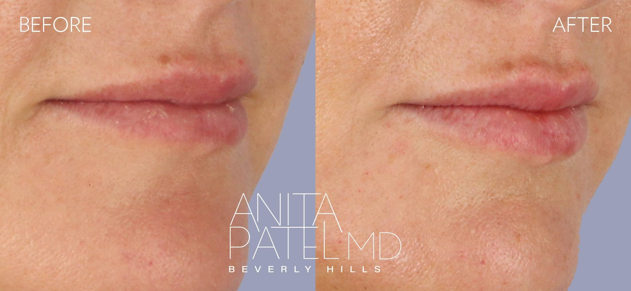 THERMIsmooth® Face Skin Tightening before and after — Patient 2, photo 2 of 3 — Dr. Anita Patel, MD, FACS, Beverly Hills