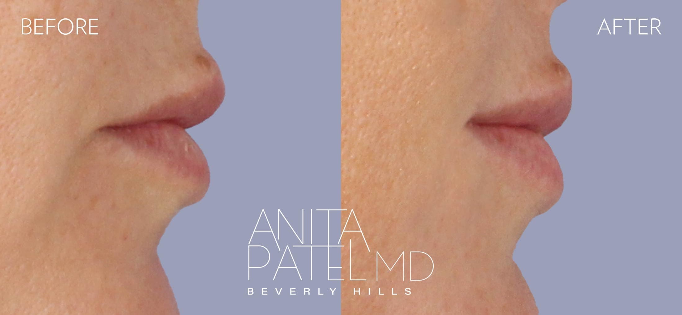 THERMIsmooth® Face Skin Tightening before and after — Patient 2, photo 3 of 3 — Dr. Anita Patel, MD, FACS, Beverly Hills