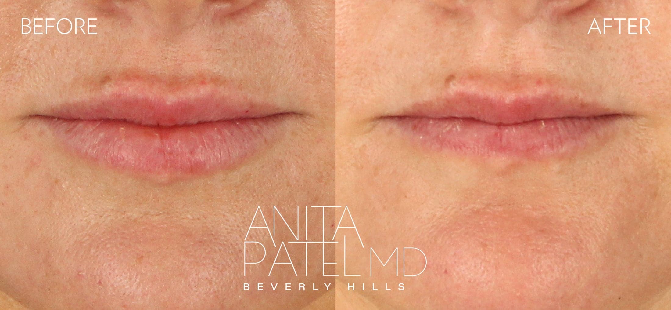 THERMIsmooth® Face Skin Tightening before and after — Dr. Anita Patel, Beverly Hills