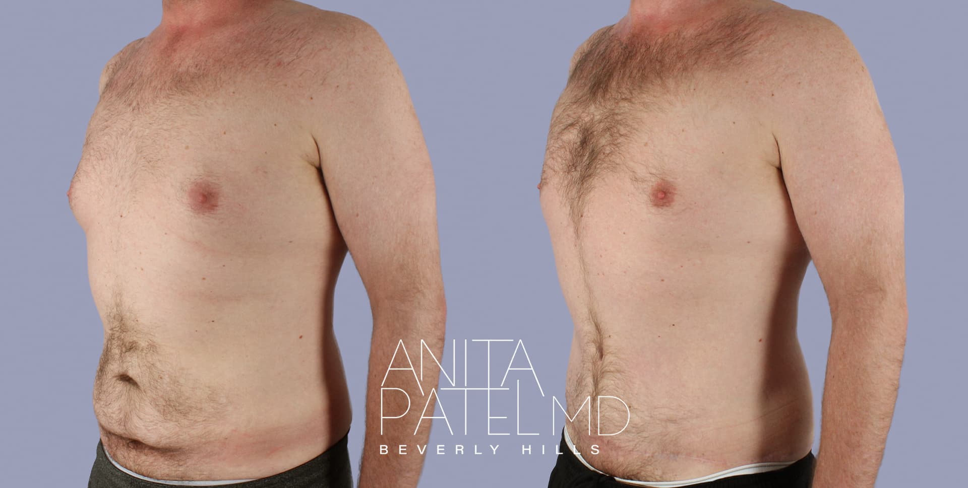 Tummy Tuck before and after — Patient 3 — Dr. Anita Patel, MD, FACS, Beverly Hills