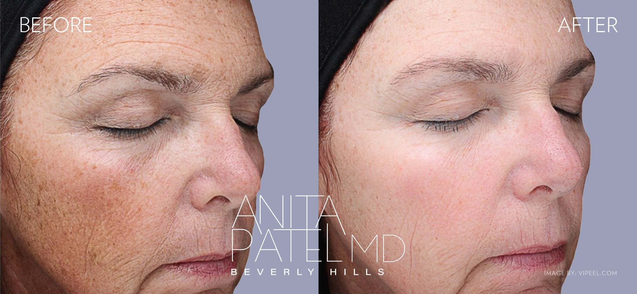 VI Peel® Anti-Aging Chemical Peels in Beverly Hills before and after — Patient 2 — Dr. Anita Patel, MD, FACS, Beverly Hills