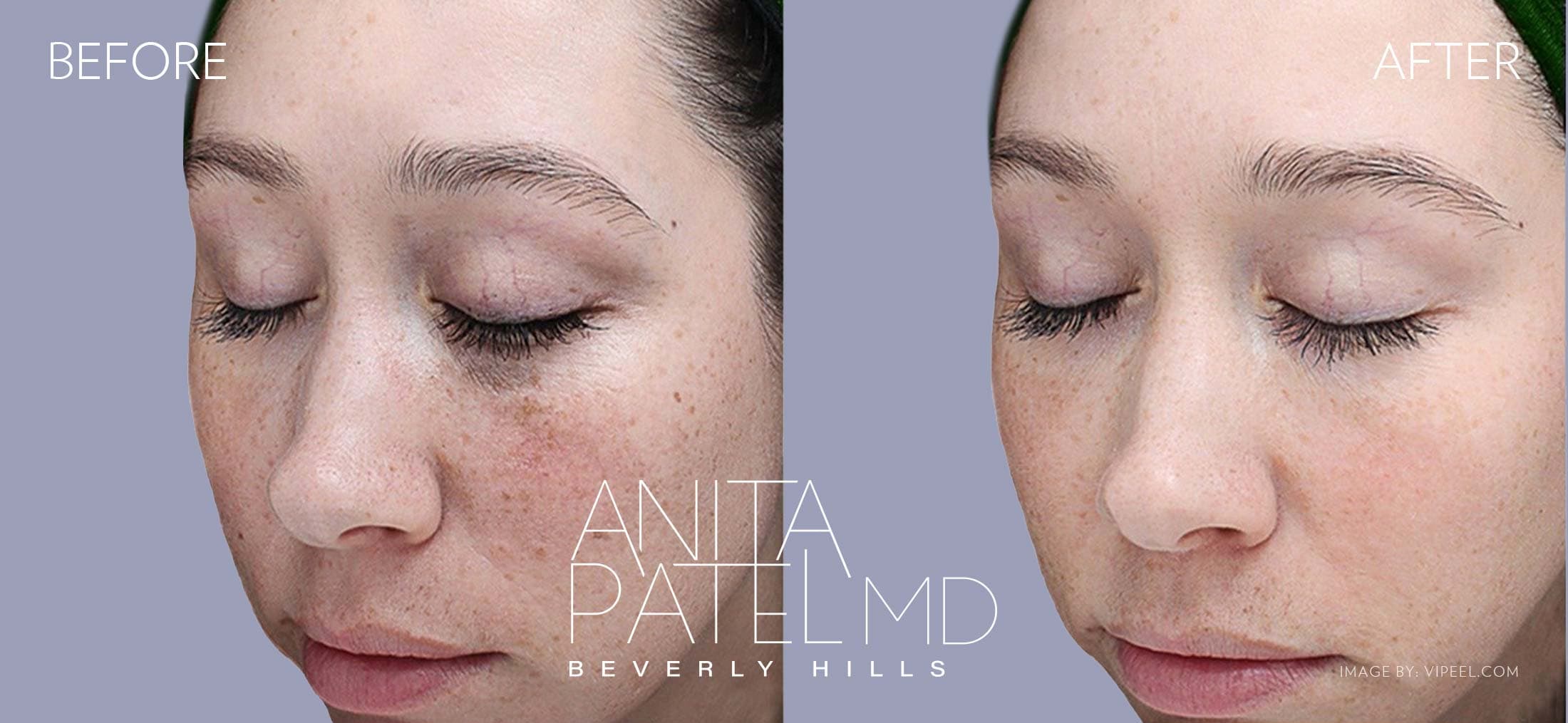 VI Peel® Anti-Aging Chemical Peels in Beverly Hills before and after — Patient 3 — Dr. Anita Patel, MD, FACS, Beverly Hills