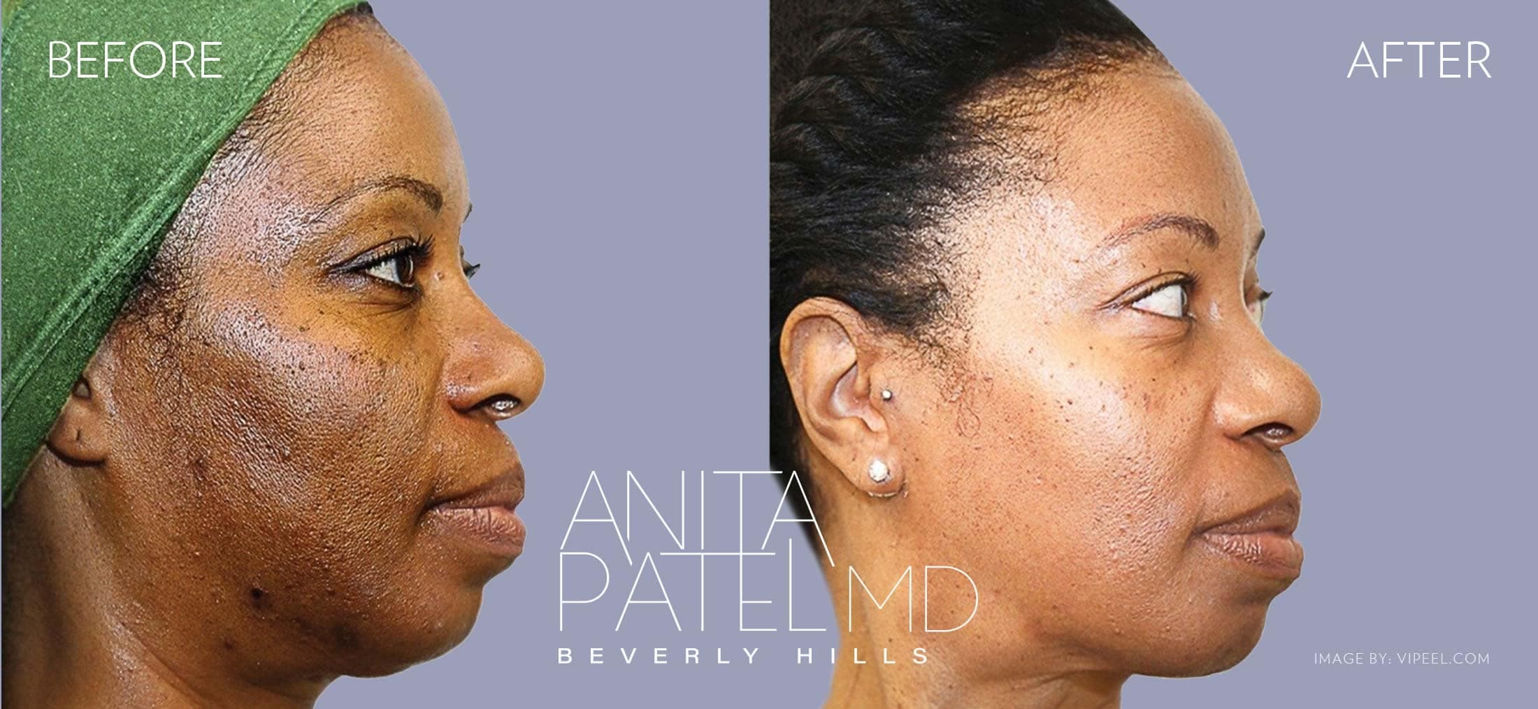 VI Peel® Anti-Aging Chemical Peels in Beverly Hills before and after — Patient 5 — Dr. Anita Patel, MD, FACS, Beverly Hills
