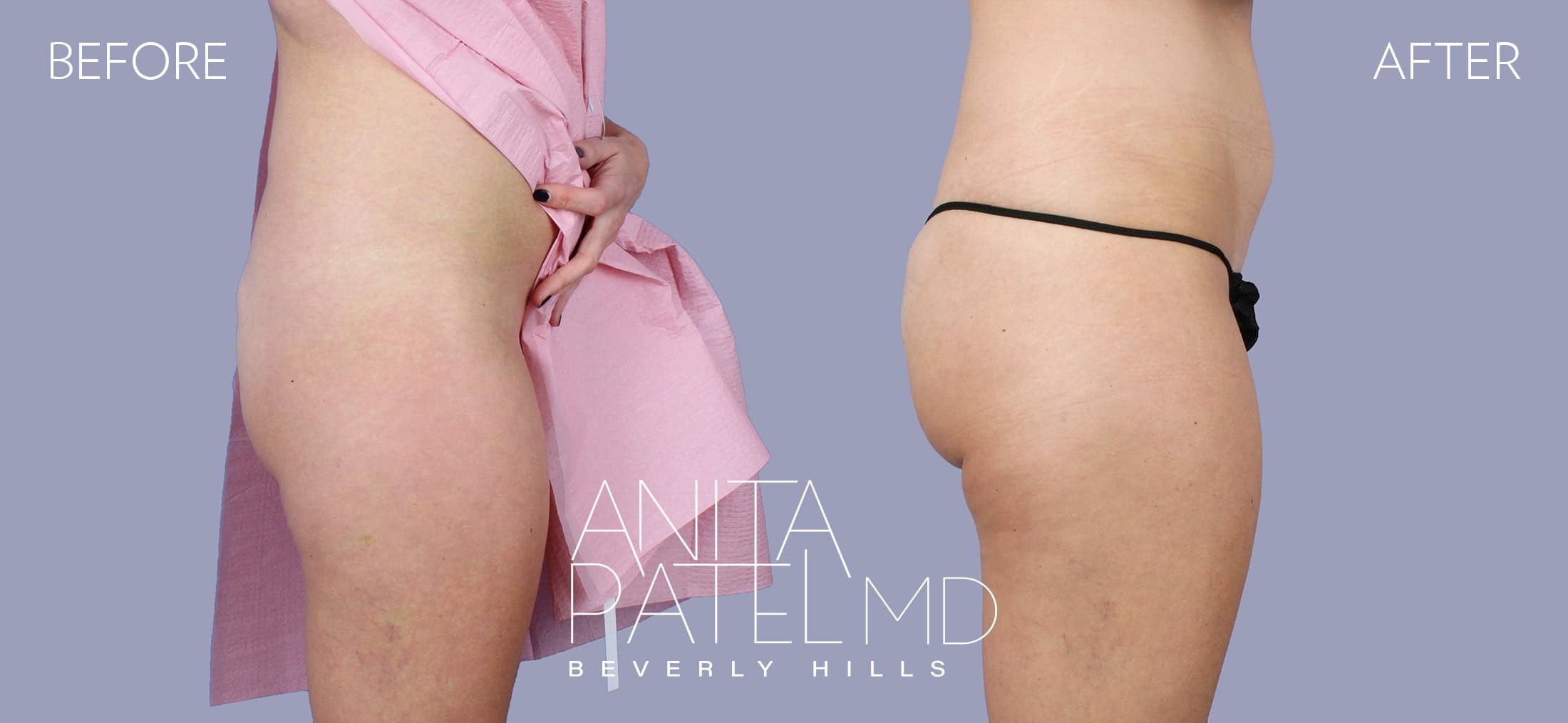 Venus RF Body before and after — Patient 1 — Dr. Anita Patel, MD, FACS, Beverly Hills
