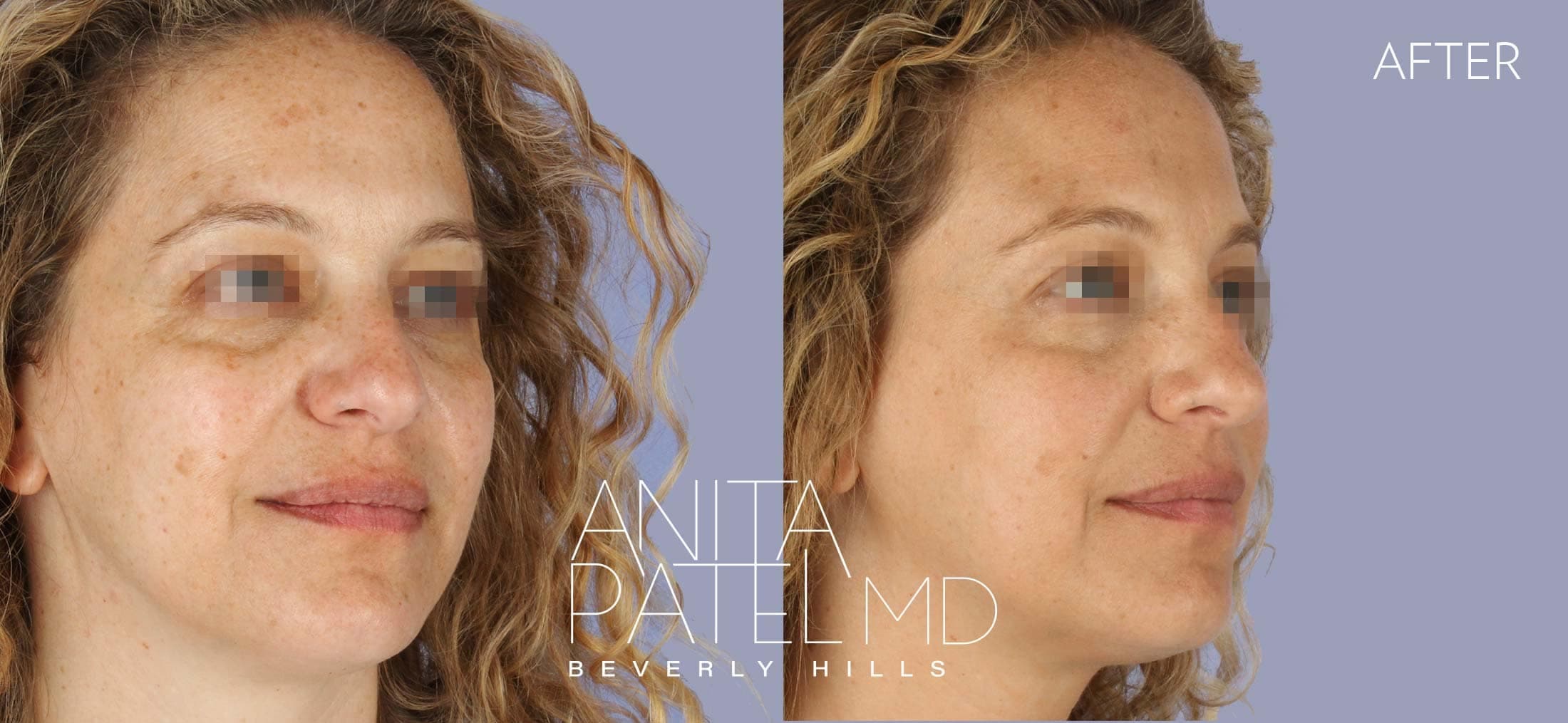 Venus RF Face before and after — Patient 1, photo 2 of 3 — Dr. Anita Patel, MD, FACS, Beverly Hills