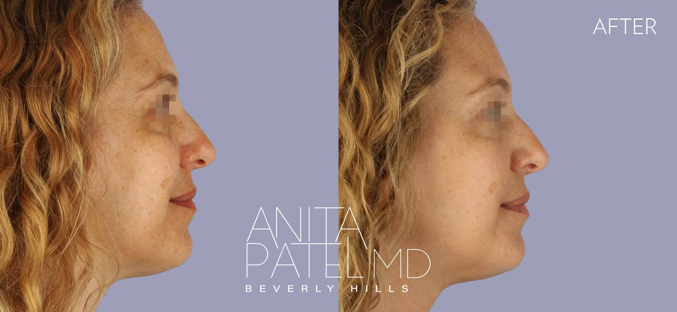 Venus RF Face before and after — Patient 1, photo 3 of 3 — Dr. Anita Patel, MD, FACS, Beverly Hills