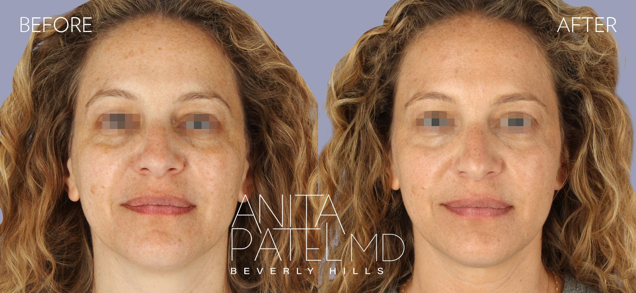 Venus RF Face before and after — Patient 1, photo 1 of 3 — Dr. Anita Patel, MD, FACS, Beverly Hills