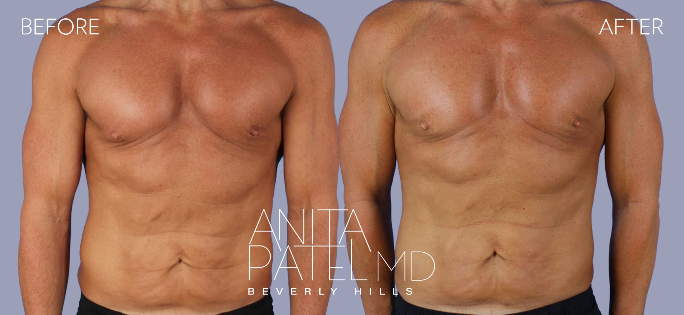 Venus RF Body before and after — Patient 3 — Dr. Anita Patel, MD, FACS, Beverly Hills